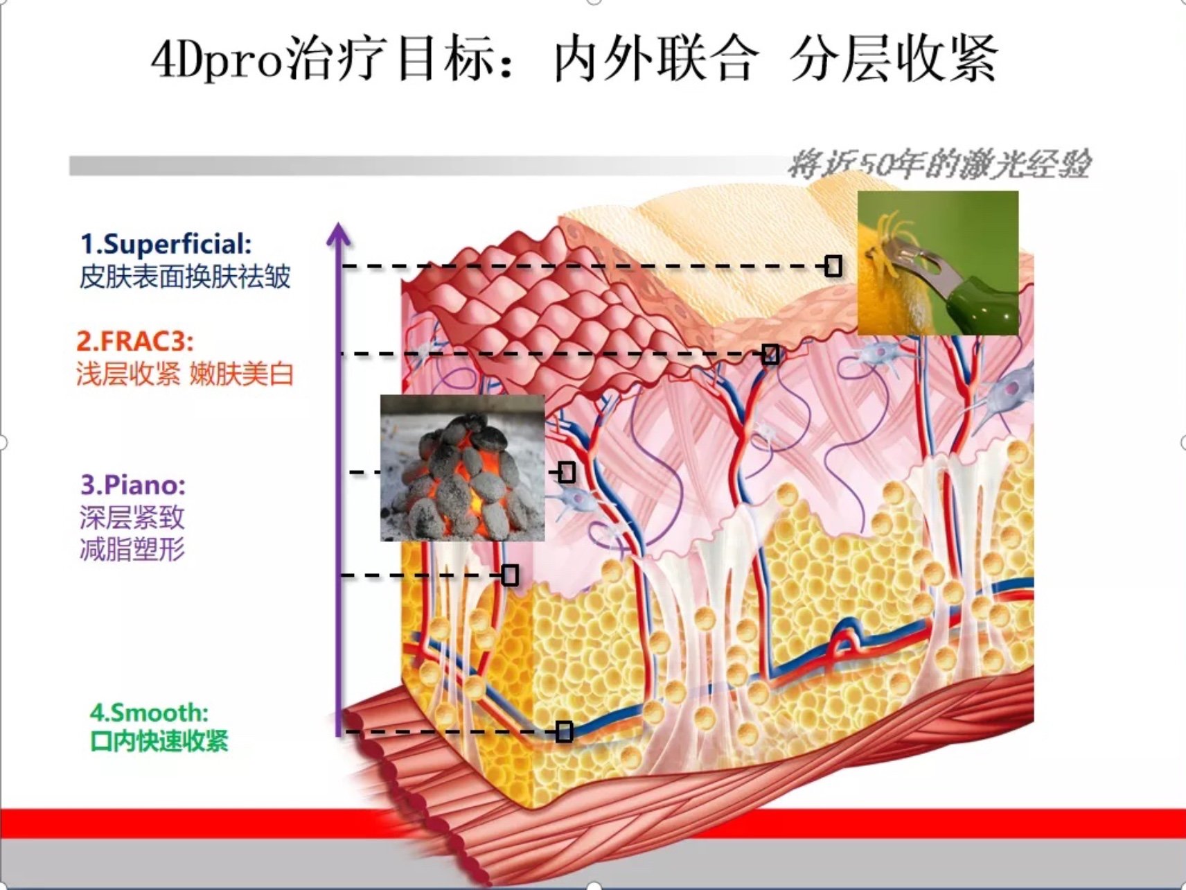 热玛吉,热拉提plus,fotona4d