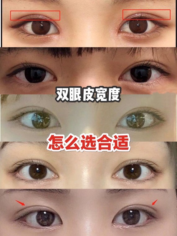 适合亚洲人的双眼皮宽度是6到8mm78但7mm6mm的双眼皮数据没有绝对