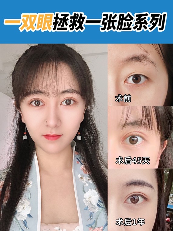 949494选择适合自己的双眼皮非常重要,每个人的眼型不_圈子
