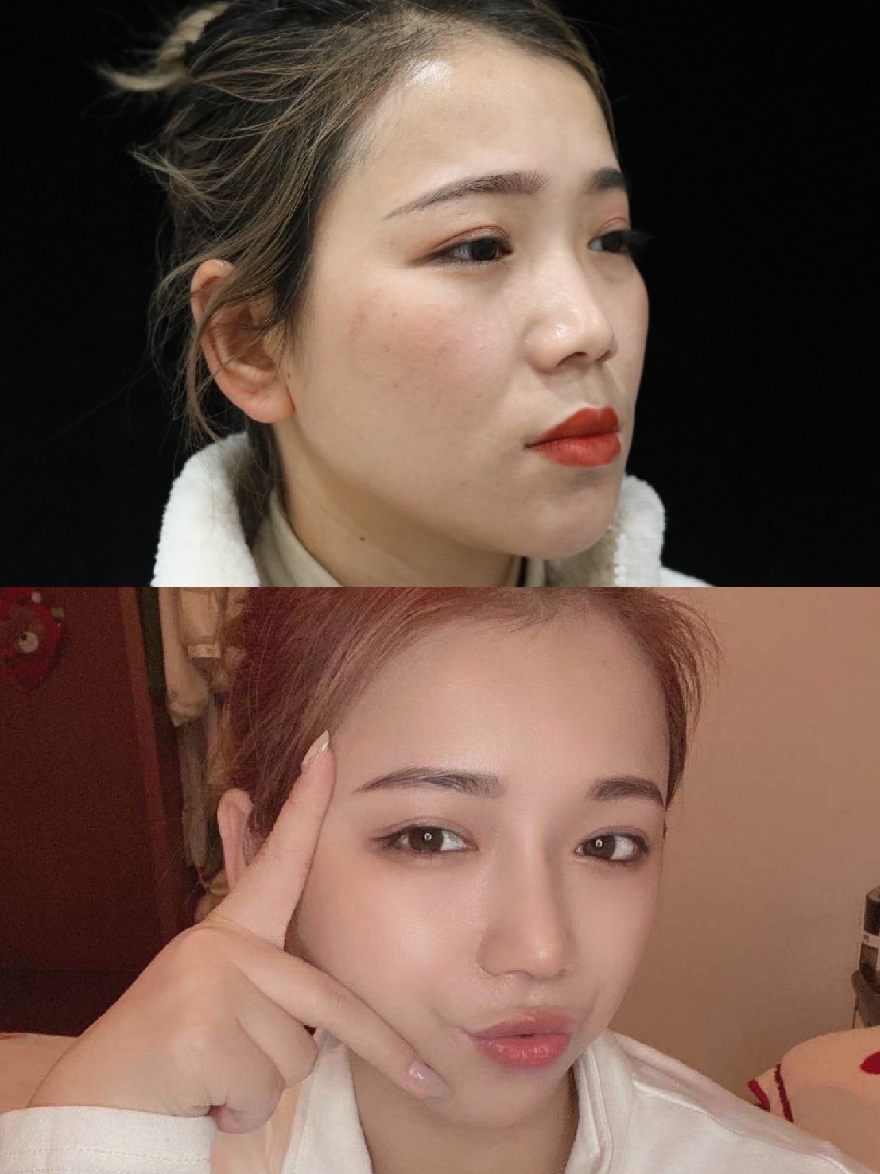 鼻背低,山根_圈子-新氧美容整形