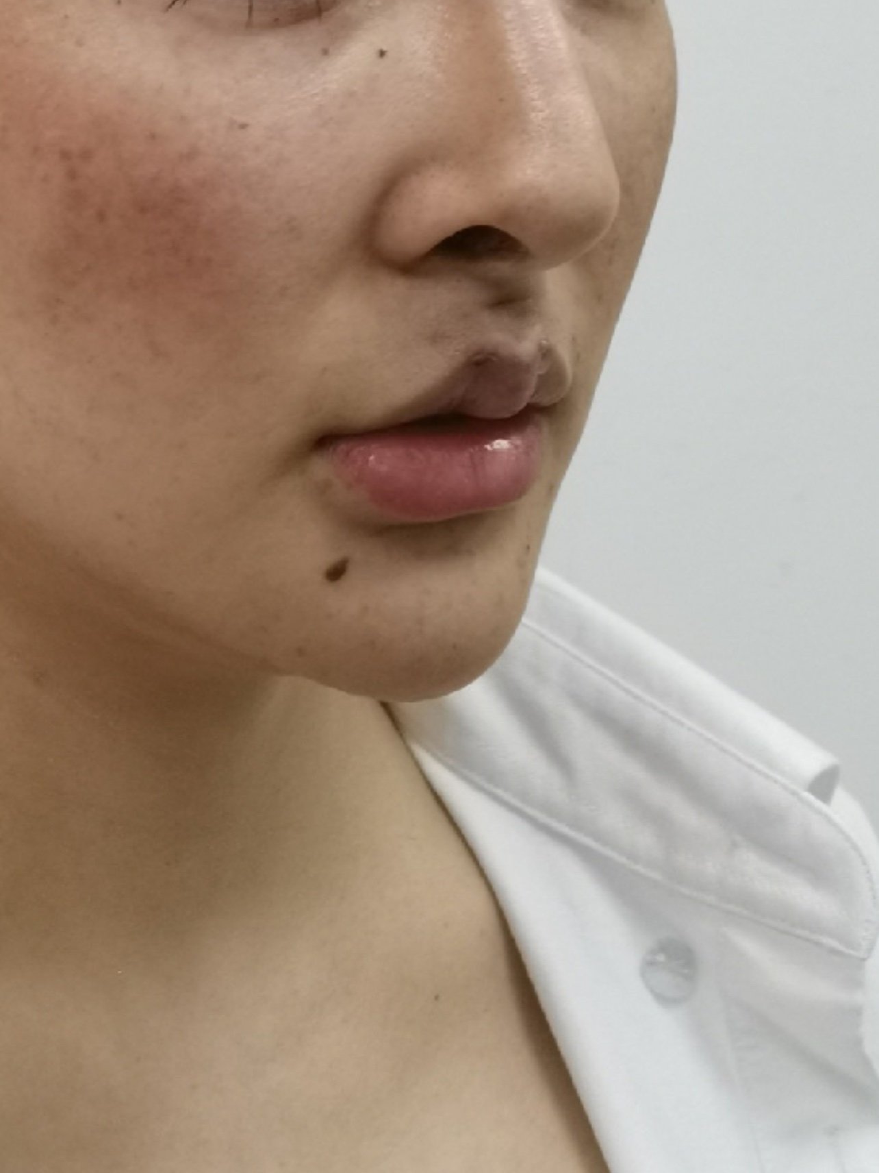 无痕人中缩短术埋线人中术后当天