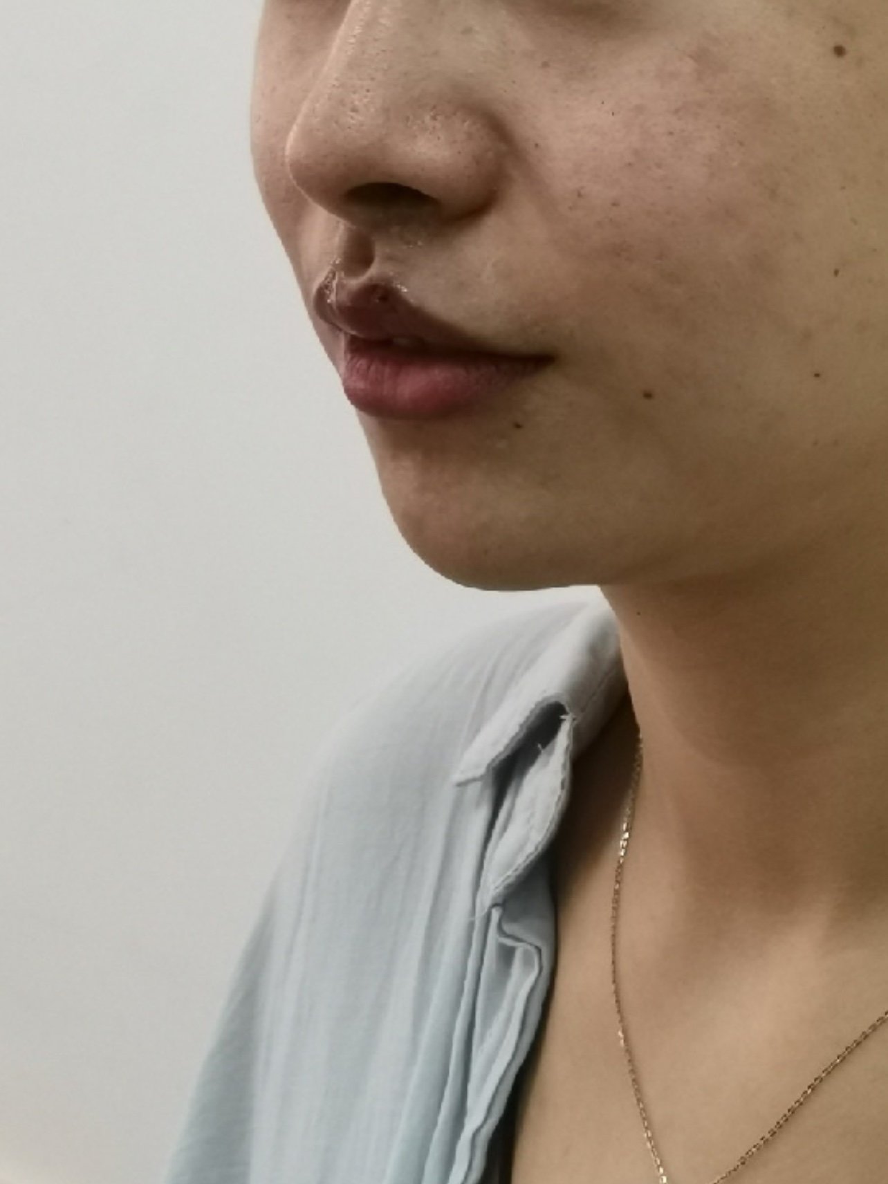 刚做完埋线人中缩短术,本来人中不是特别长,但是想更