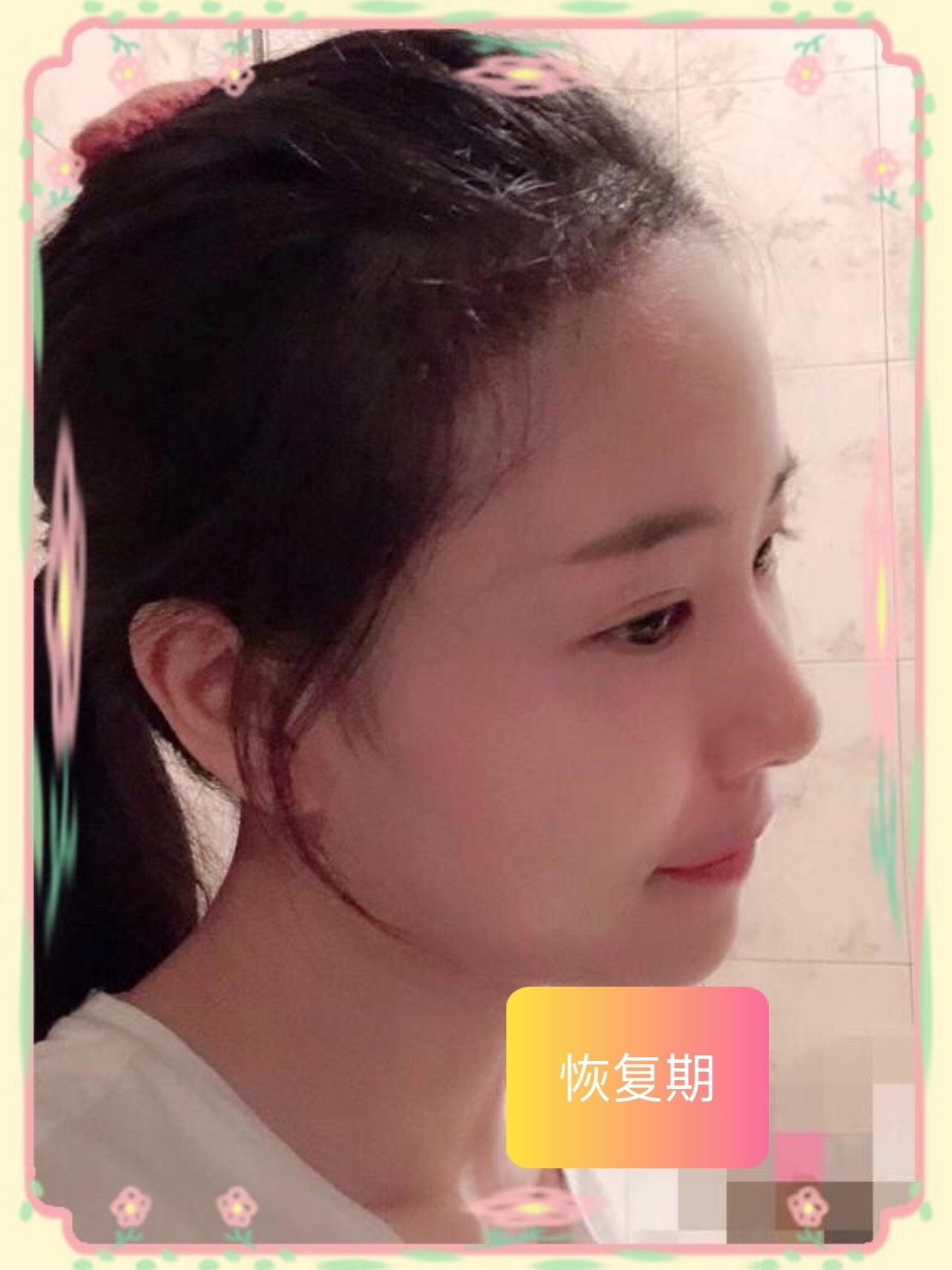 发际线种植了一个月左右侧面看真的很好看,很满意,现_圈子-新氧美容