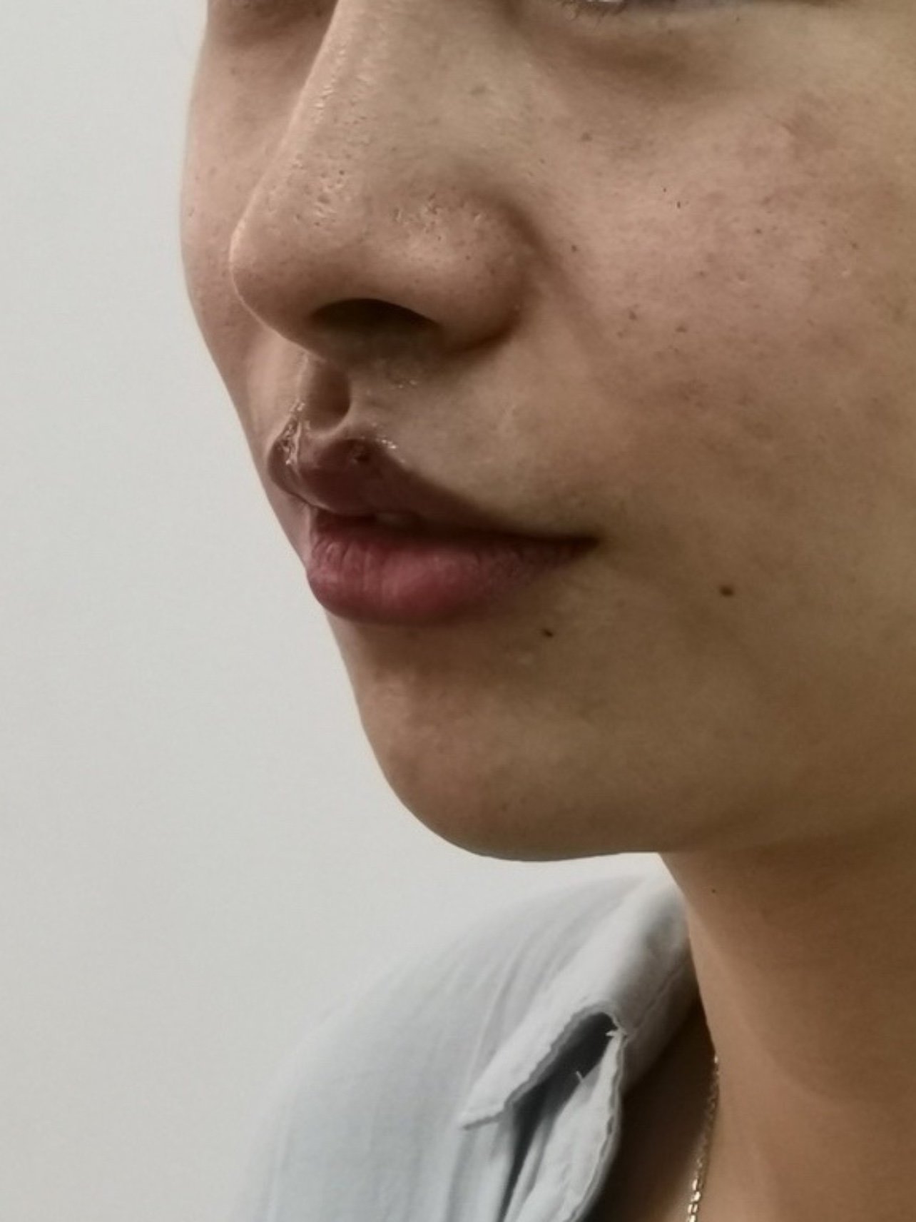 取颊脂垫瘦脸术后第一天
