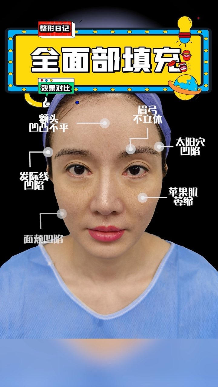 脂肪填充改善:额头凹凸不平,发际线,太阳穴凹陷,苹_圈子-新氧美容整形