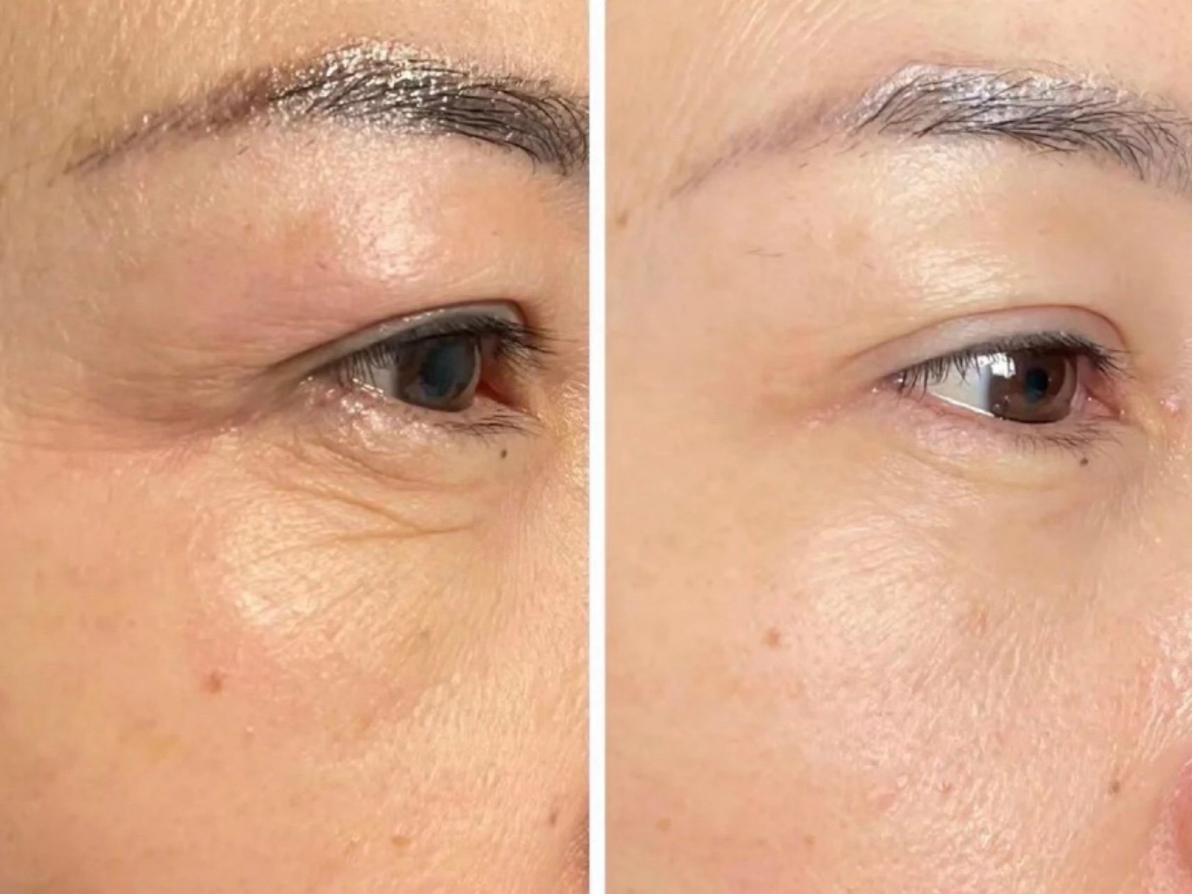 这次做了一个去皱的项目,因为自己的眼纹特别严重,显_圈子-新氧美容