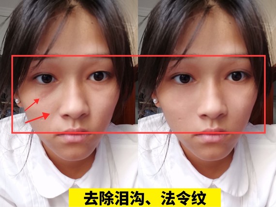 有不少人被龙凤眼困扰,龙凤眼最常见的问题就是大小眼,那么龙凤眼该