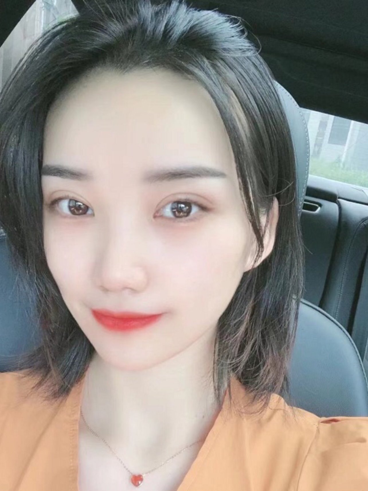 术前单眼皮眼距宽水肿眼睛无美感