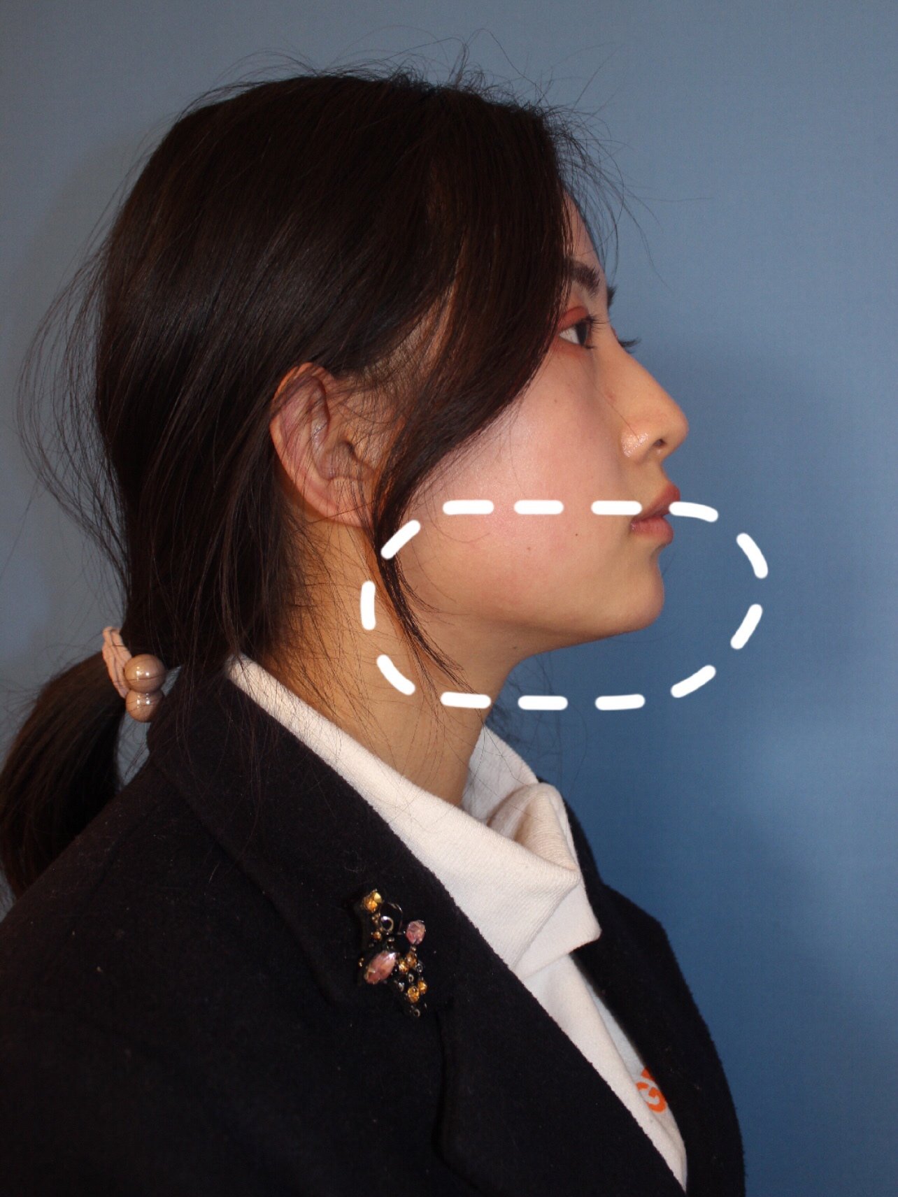 爱美者术前下颌缘不清晰,咬肌比较发达.