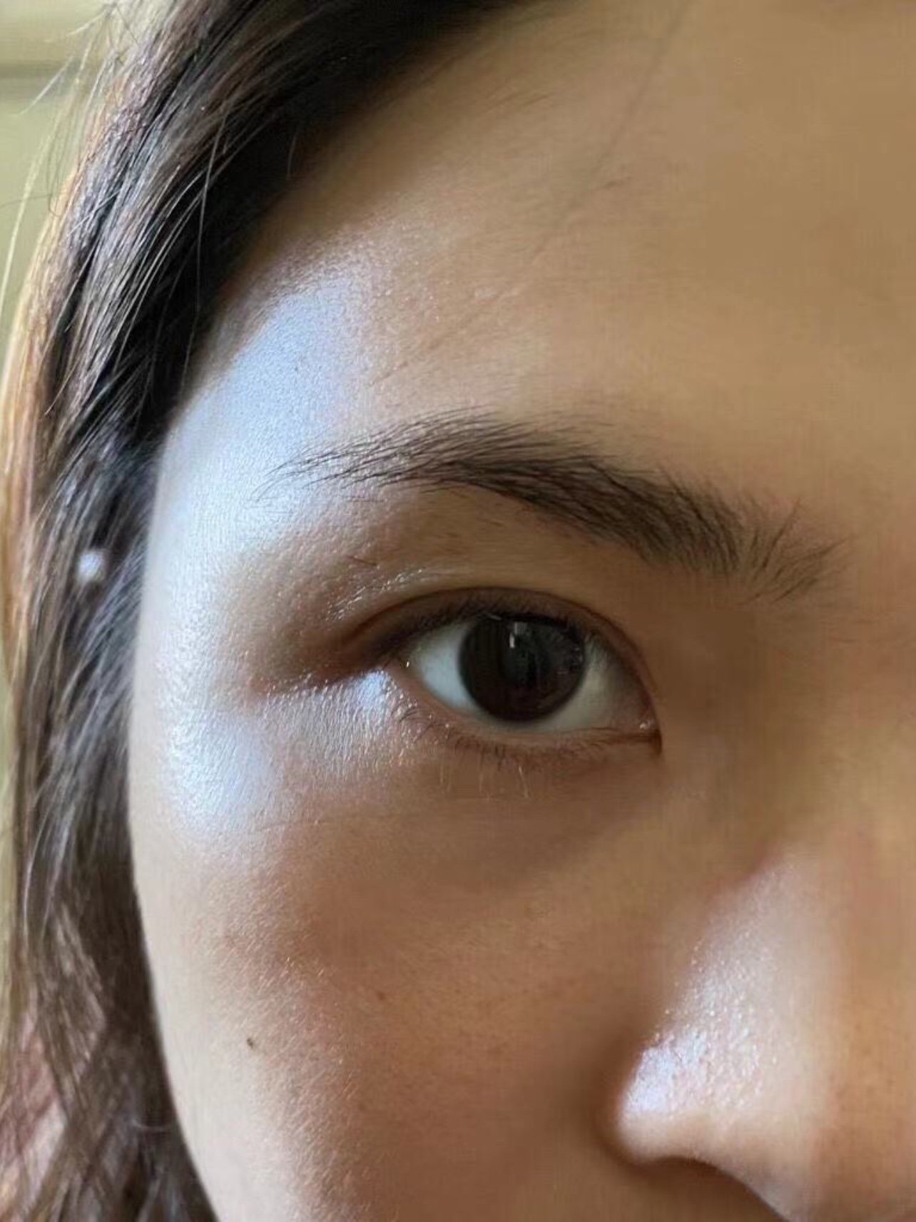 打除皱针的25天|除皱针真的很有用,我打的是眼_圈子-新氧美容整形
