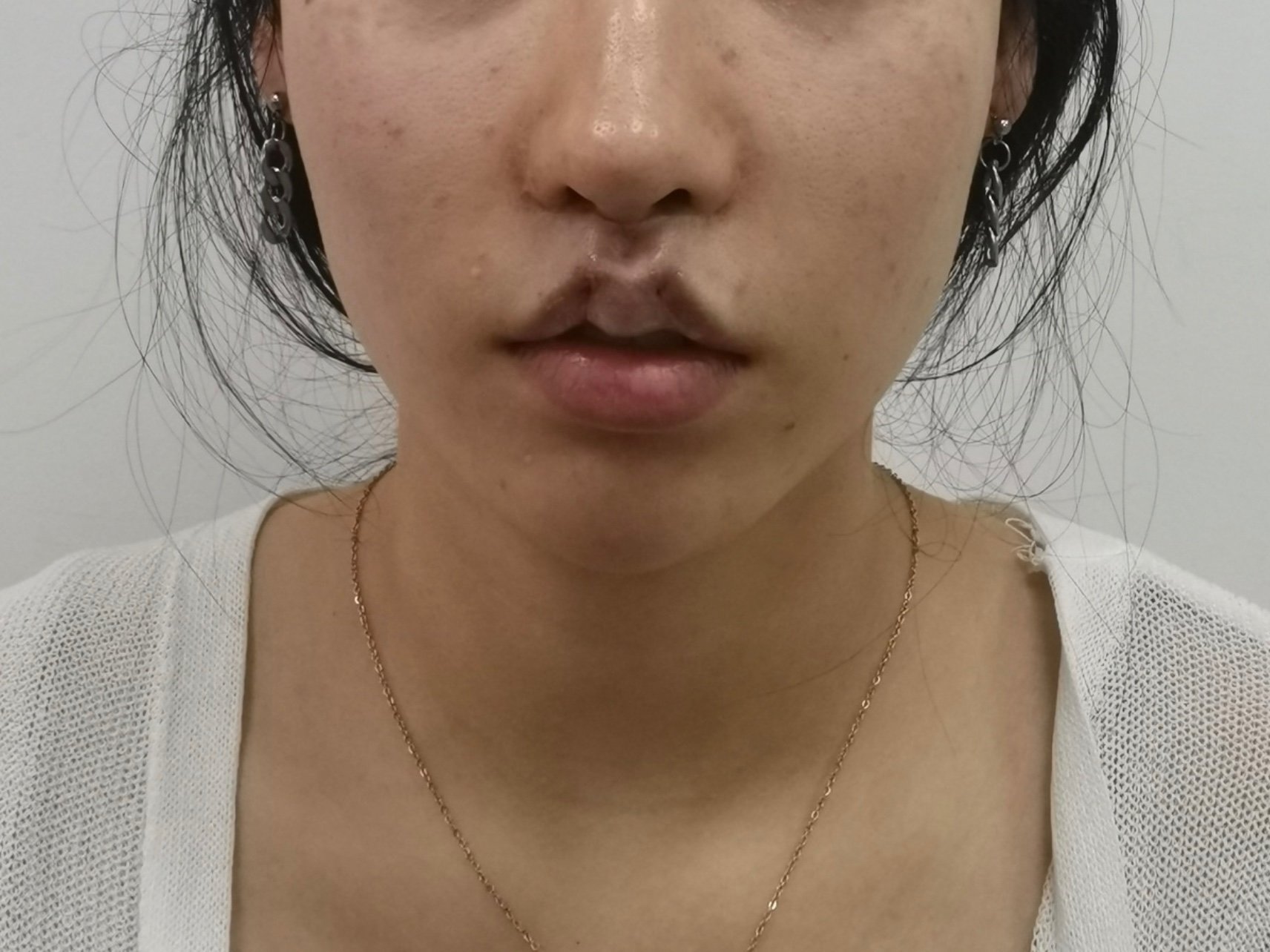 埋线人中缩短术后即刻