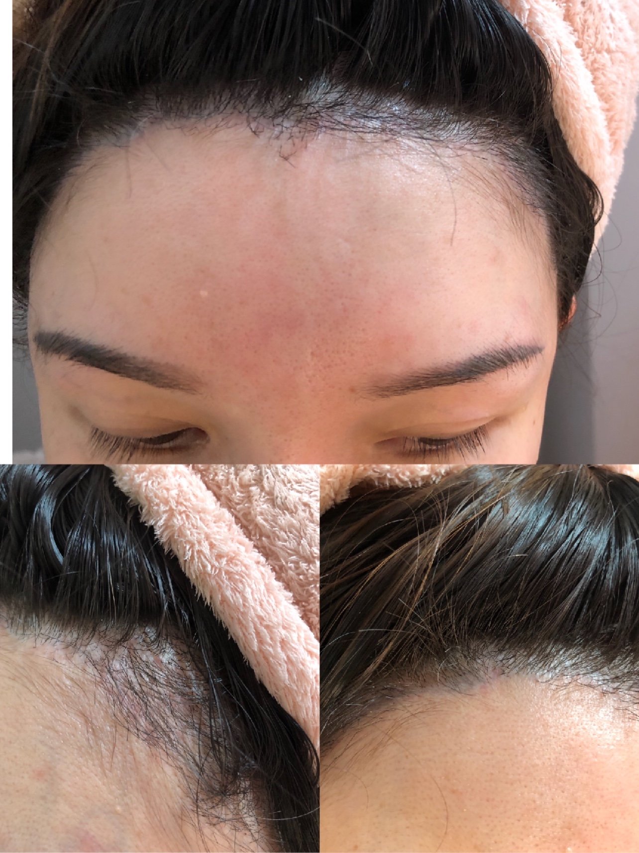 美人尖发际线种植一个月啦