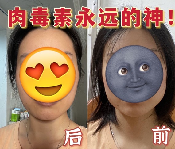 肉毒素永远的神!大家先看看对比图,这是打了一个月_圈子-新氧美容整形