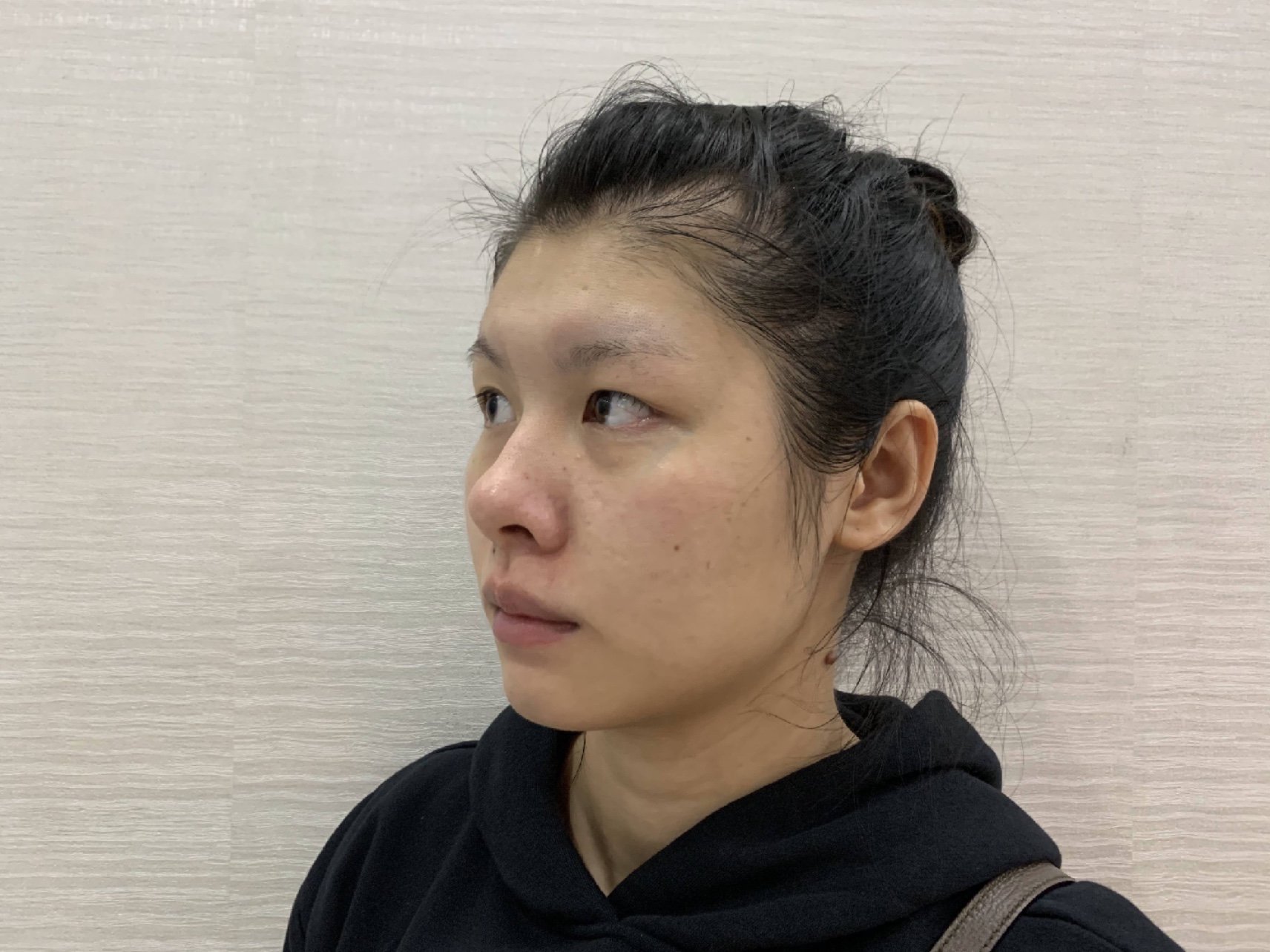 问题天生单眼皮鼻梁低正面露鼻孔