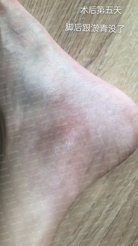 这个小姐姐做完前几天会有些微肿,脚后跟有些淤青,坚_圈子-新氧美容
