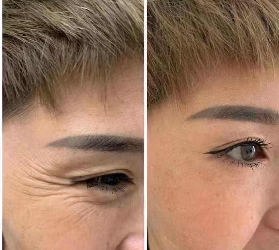 你用再昂贵的眼霜也涂不平的眼尾的皱纹除皱针一针见效皱纹显老,没有
