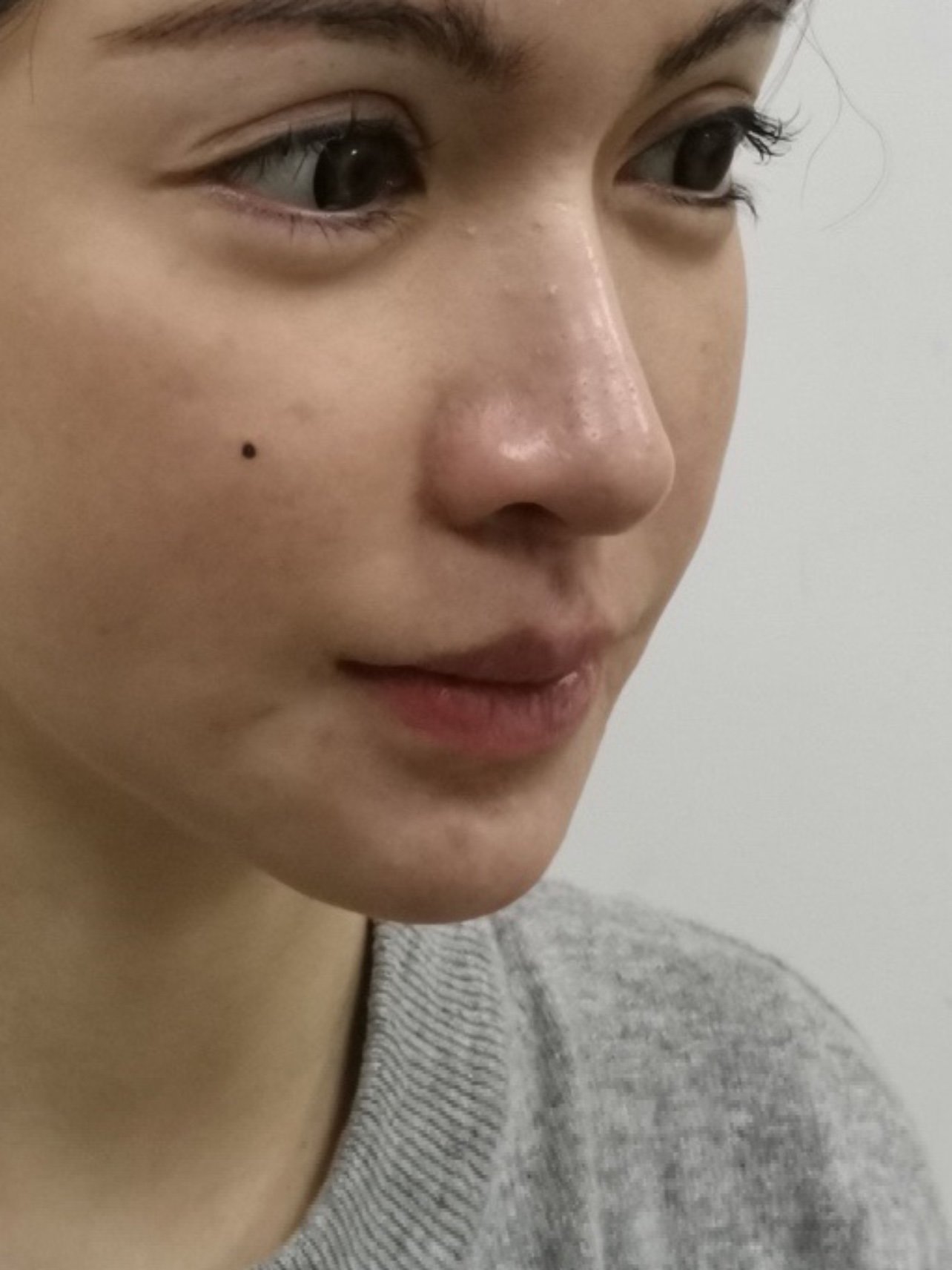 大嘴改小嘴术后26天素颜照片分享