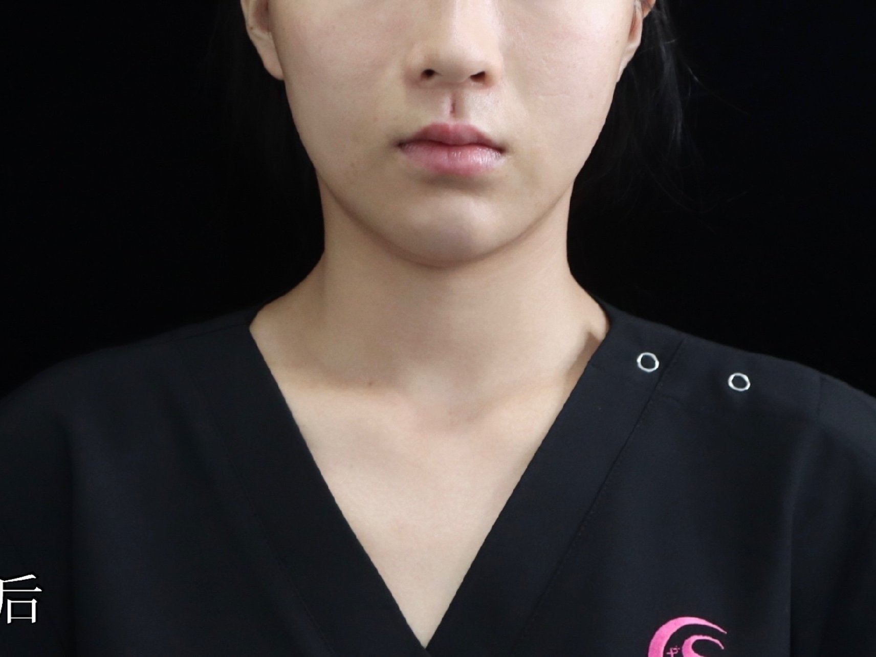 人中窝不立体,人中脊较平,人中窝成型术_圈子-新氧美容整形