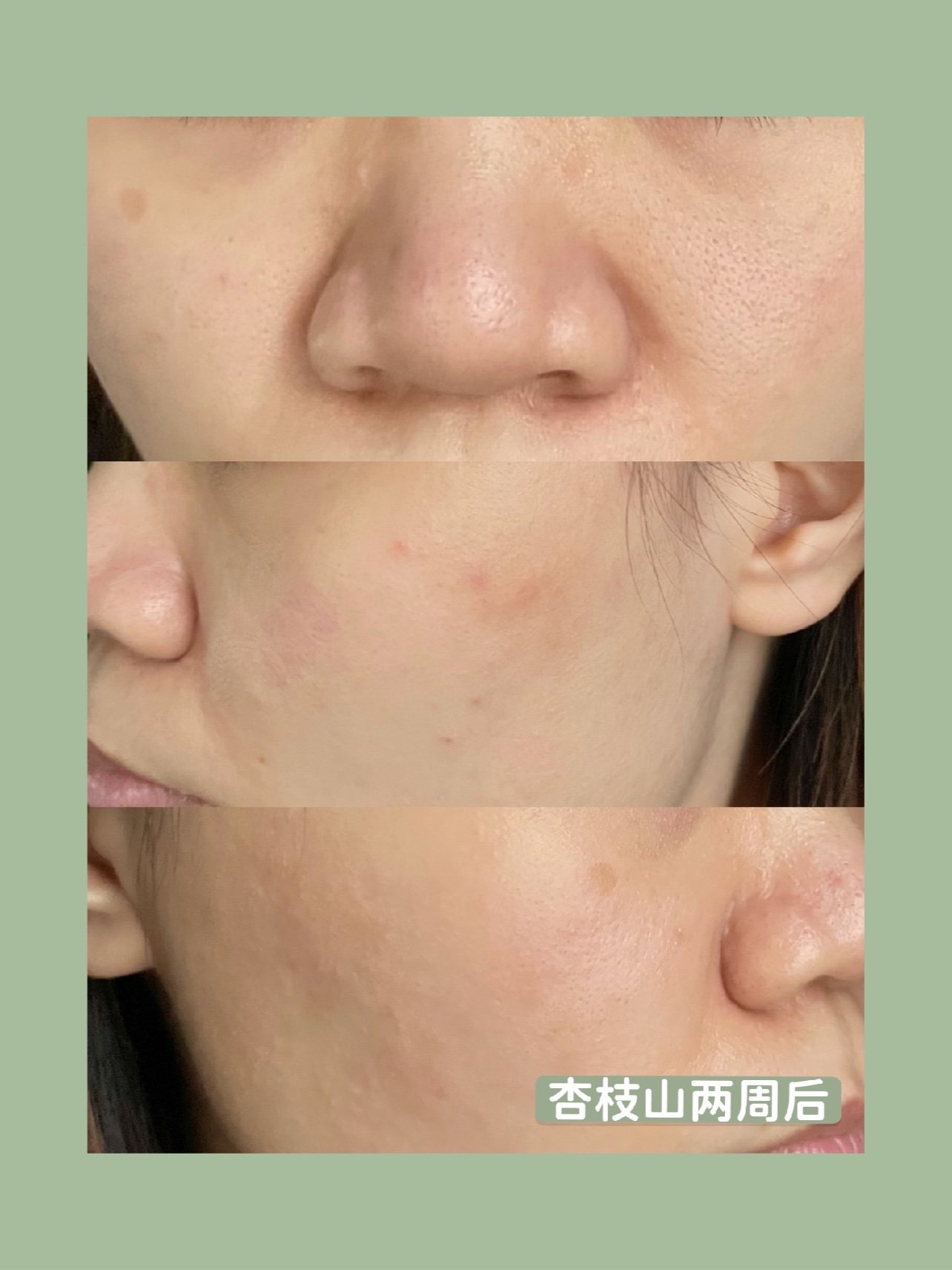 杏枝山活性祛斑