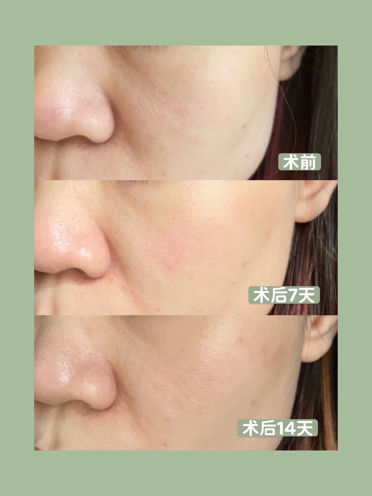 杏枝山活性祛斑