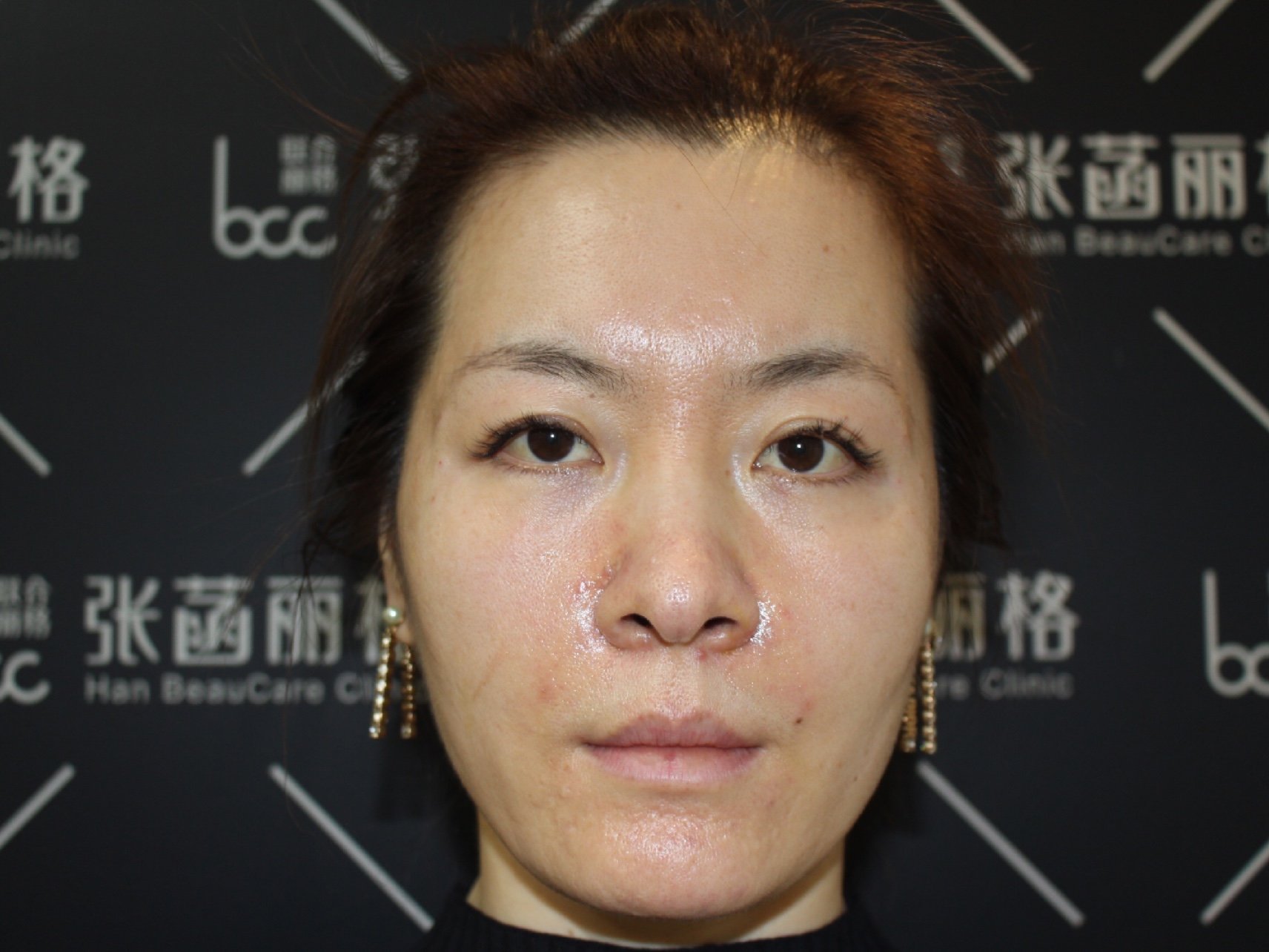 下了班过来打的玻尿酸填充鼻基底,没想到即刻的效果就_圈子-新氧美容