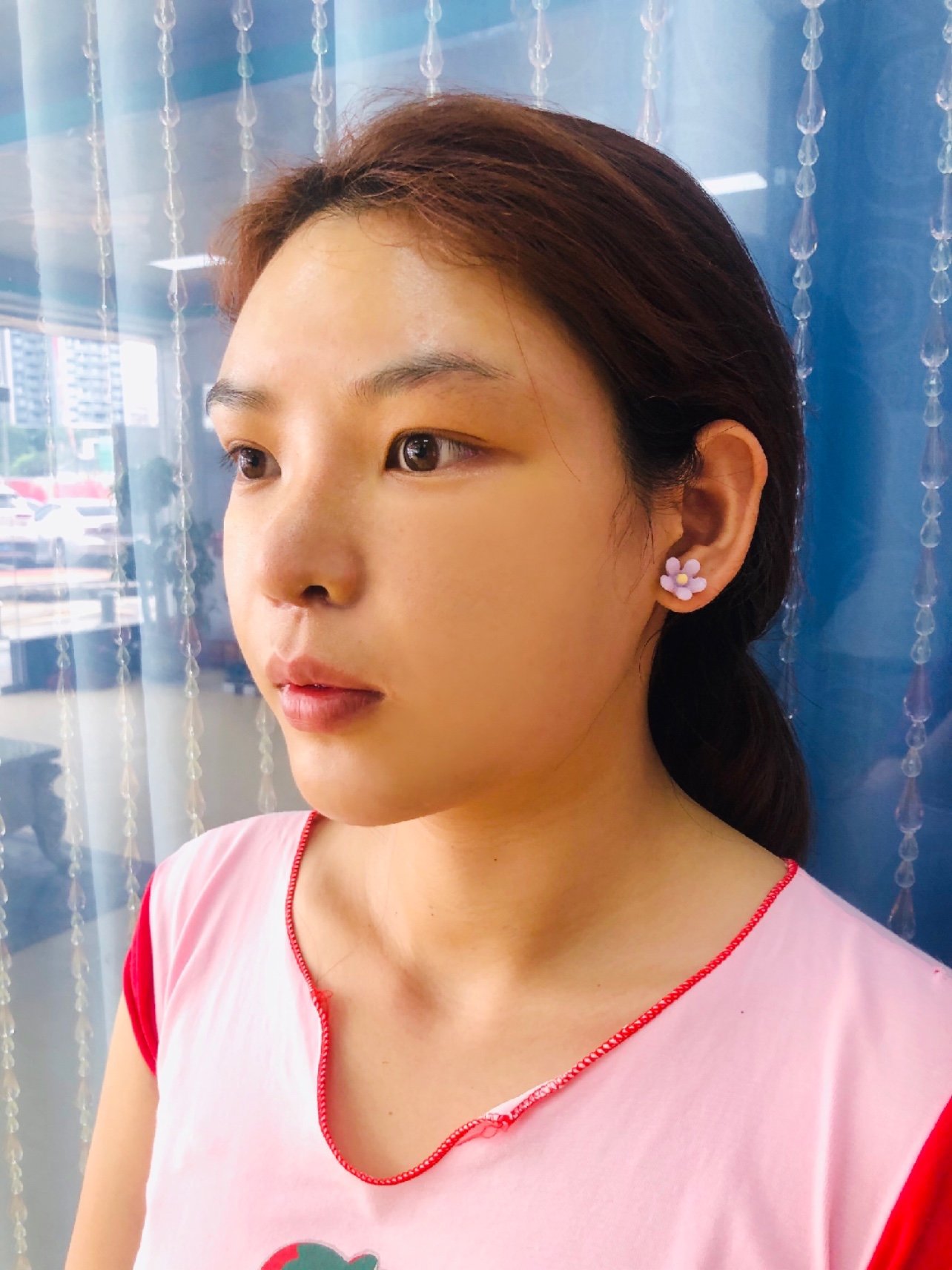 我做的是韩式鼻翼内切,内切的手术刀口很隐蔽,基本看_圈子-新氧美容