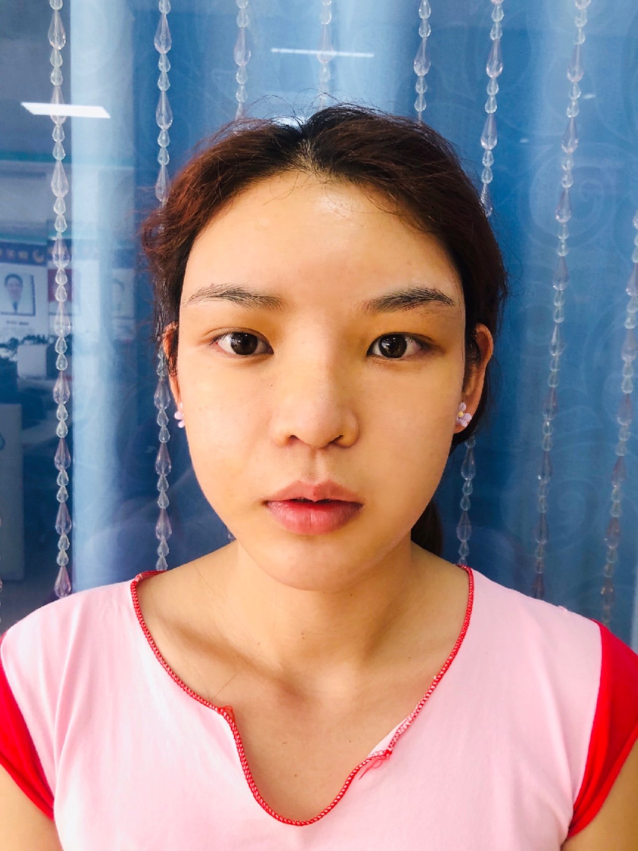 我做的是韩式鼻翼内切,内切的手术刀口很隐蔽,基本看_圈子-新氧美容