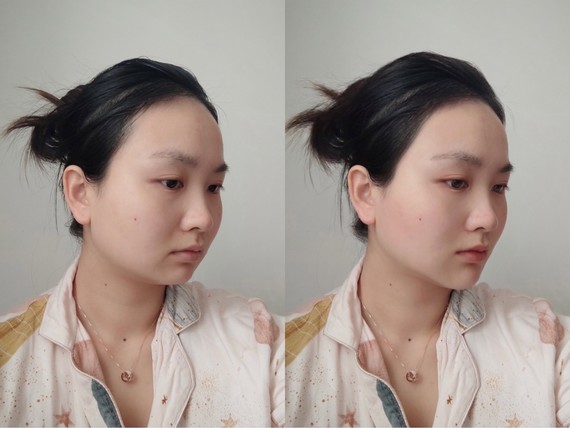 我们来看一看侧面的一个改善前后的模拟效果对比图,下巴和发际线调整