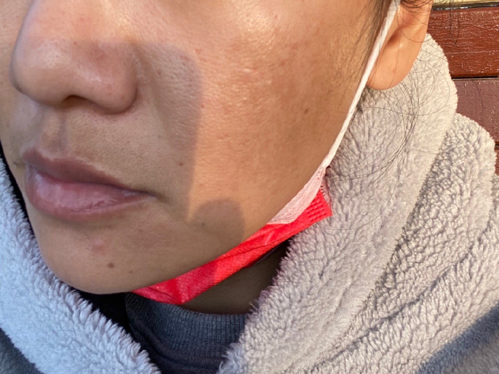 新氧试用官杏枝山祛斑