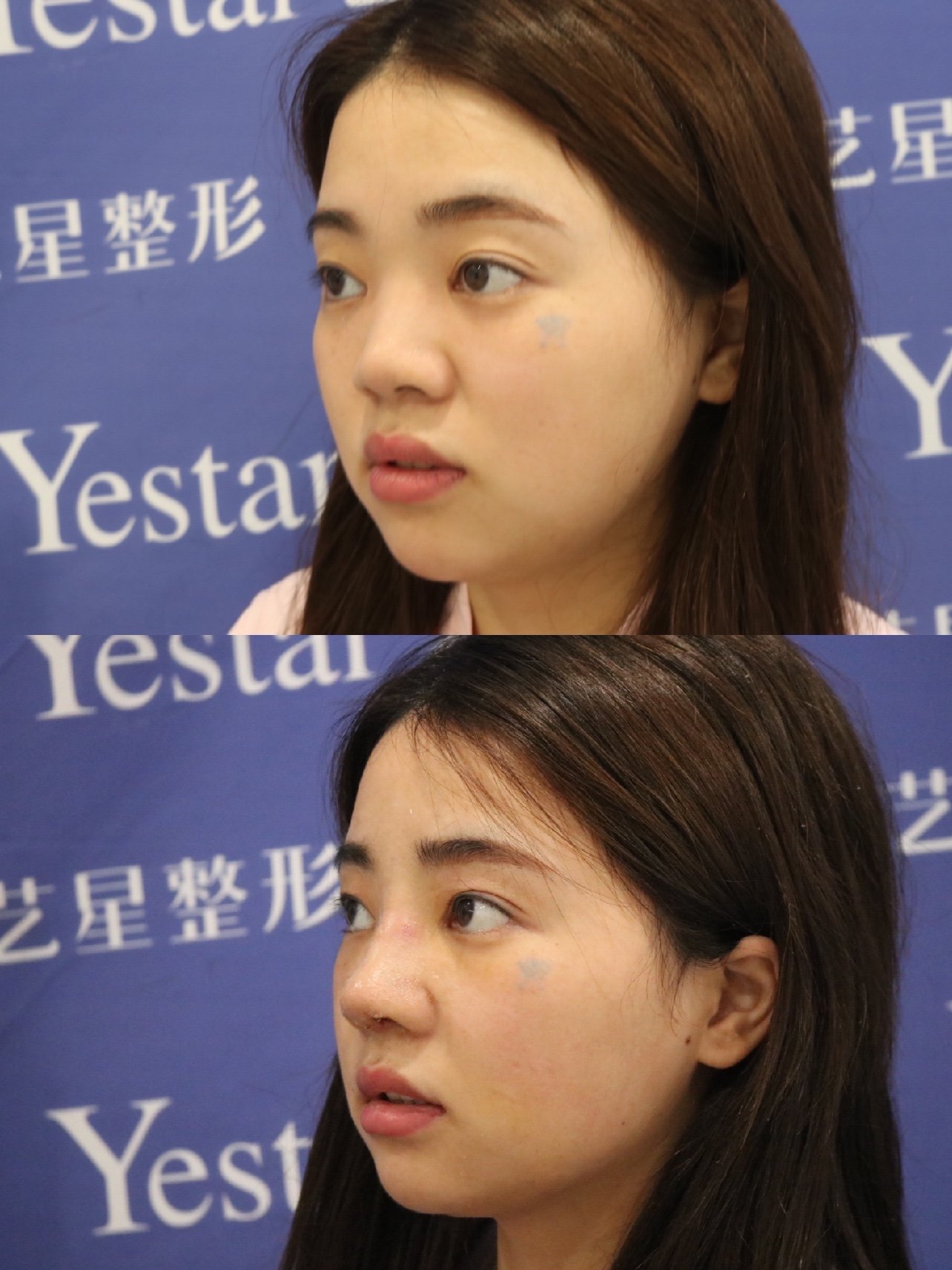 觉得自己蒜头鼻太严重了,真的非_圈子-新氧美容整形