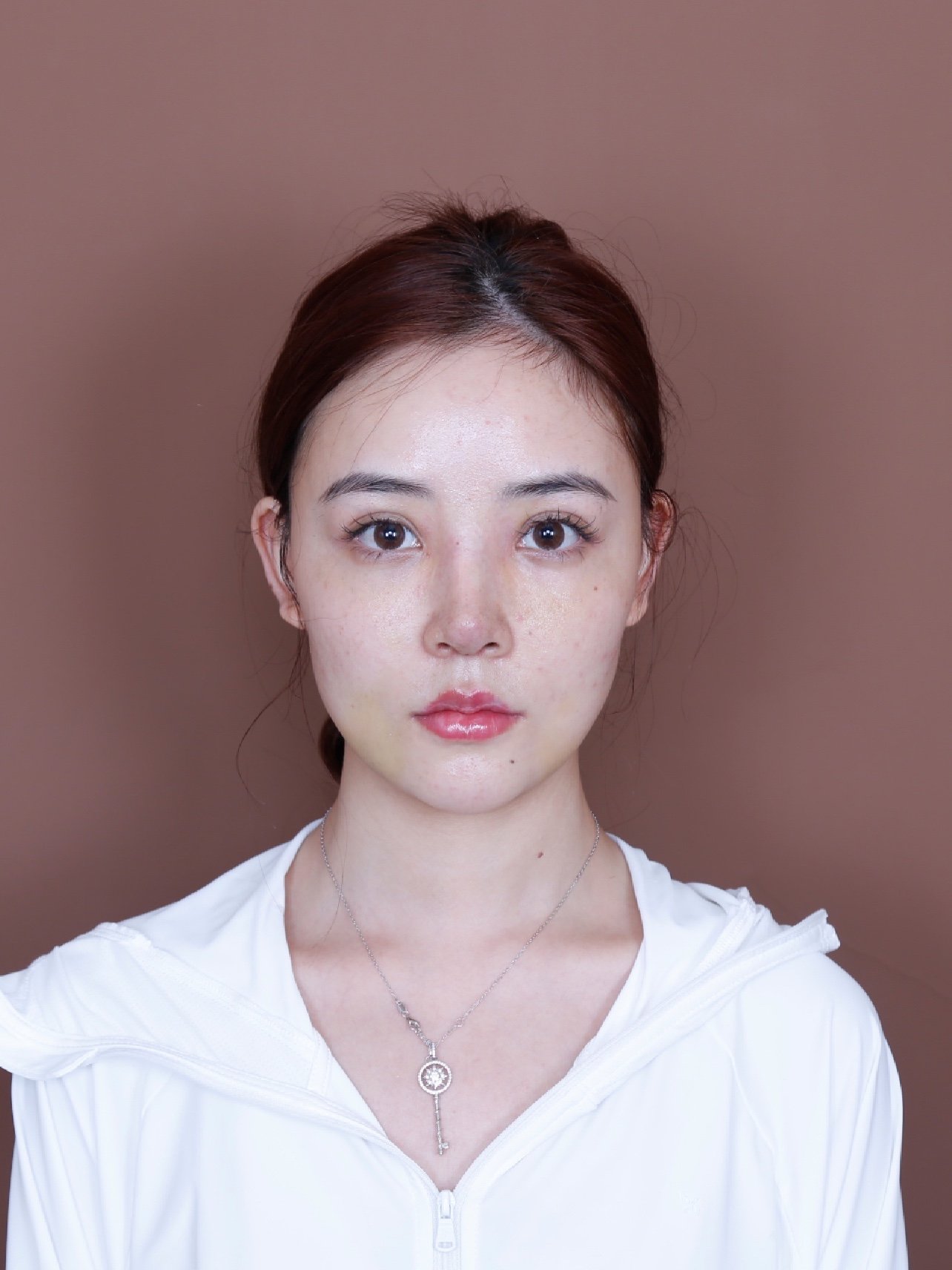 案例分析—幼态鼻91指南751597【术前-正面】鼻梁比较_圈子