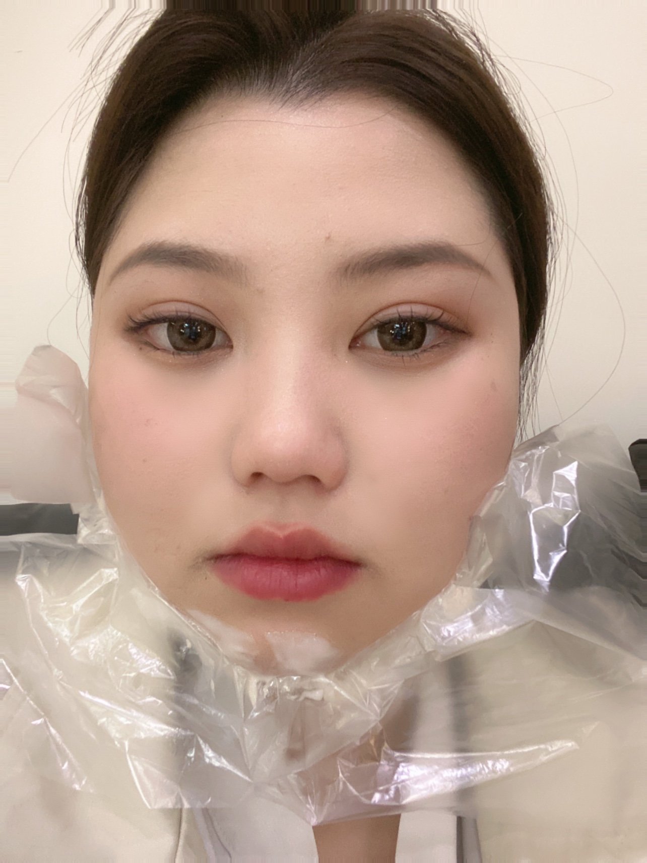 老客户了之前同事打了轮廓针超级有效果迫不及待来打一_圈子-新氧美容