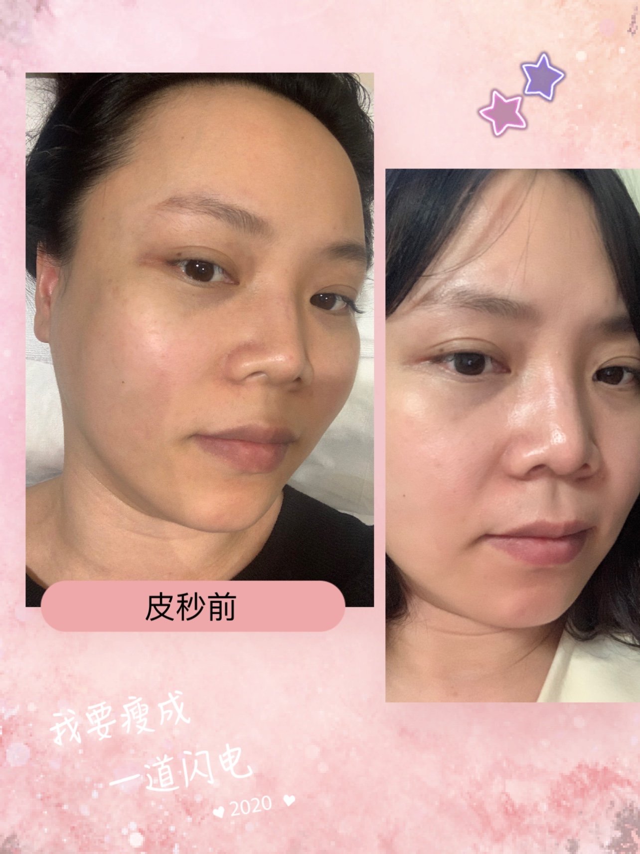 94皮秒后一天对比图新鲜出炉啦94