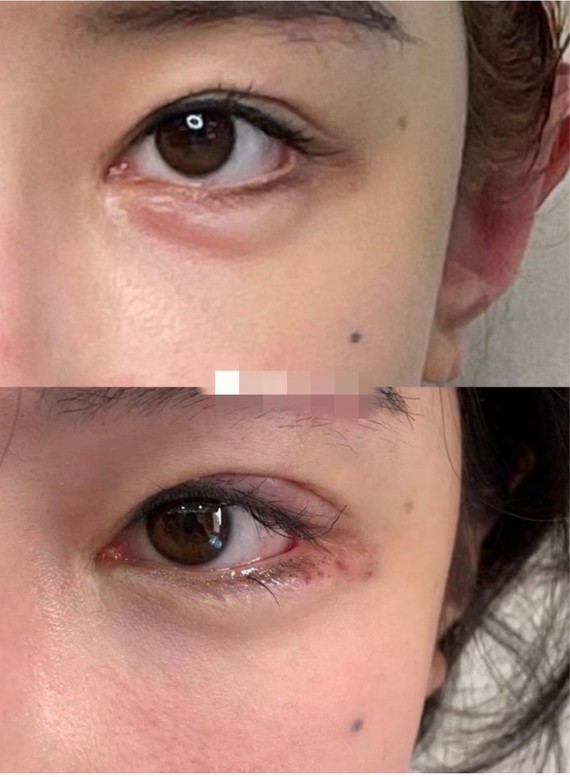 玻尿酸也能打双眼皮了7175