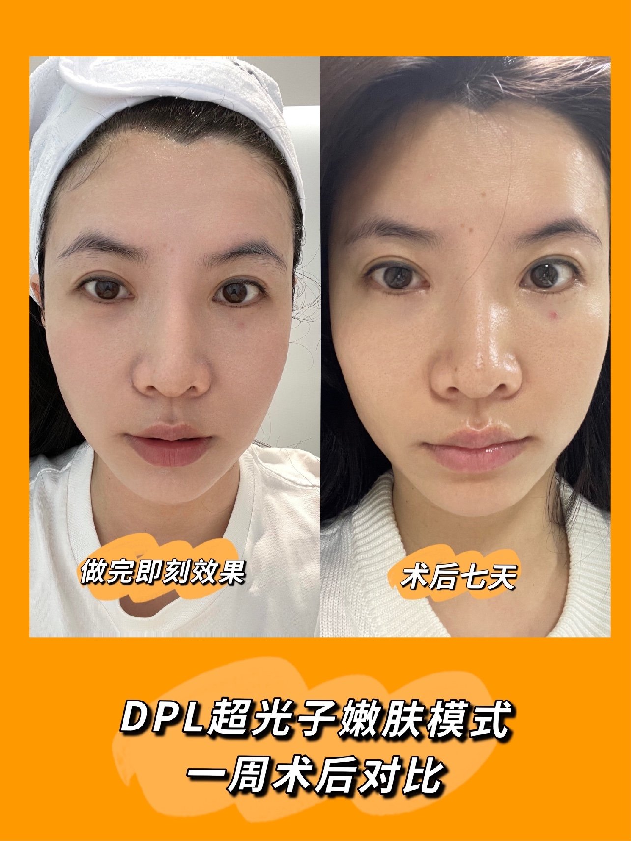 黑金超光子dpl美肤模式术后一周反馈
