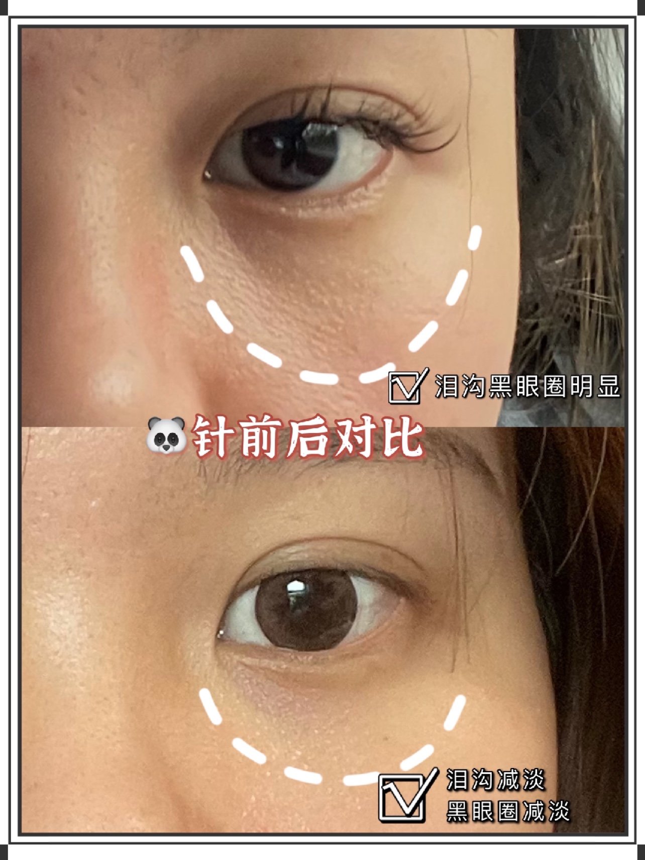 测评项目嗨体熊猫10注射泪沟黑眼圈