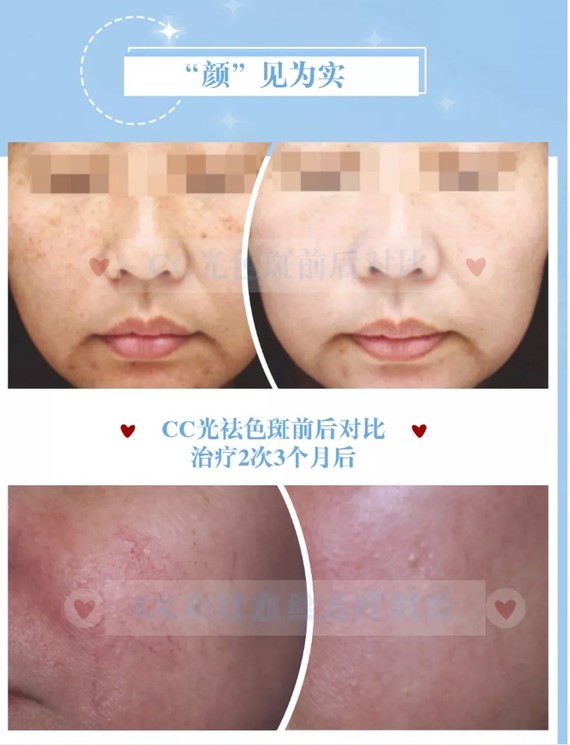 新仪器|奇致无痛cc光来啦~-----------_圈子-新氧美容整形