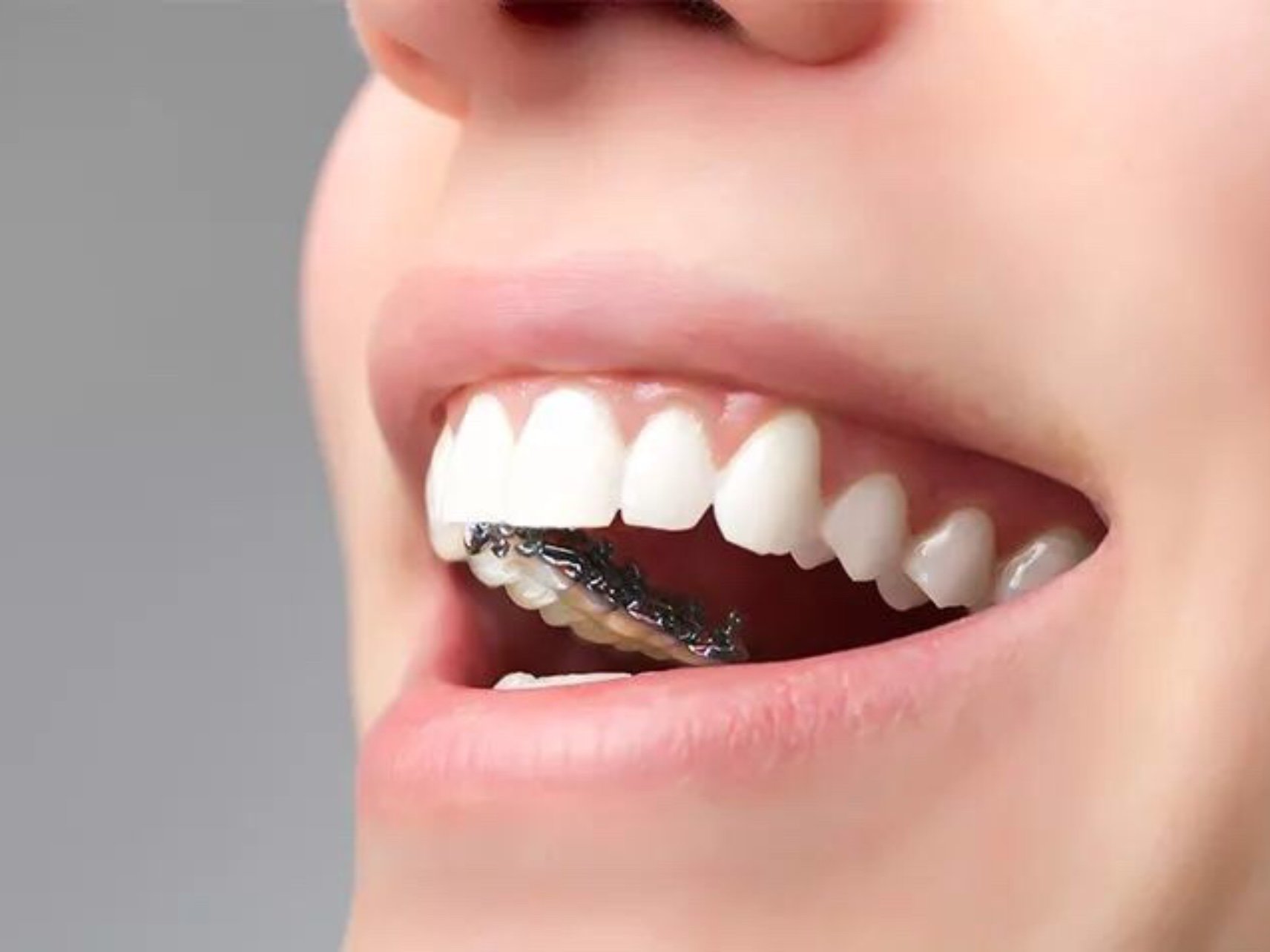 舌侧矫正和隐形矫正究竟哪个_圈子-新氧美容整形