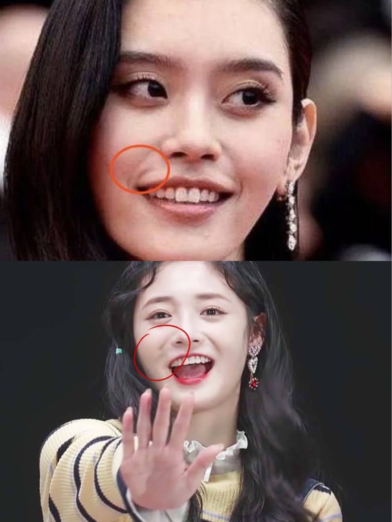 玻尿酸填充鼻基底评测报告