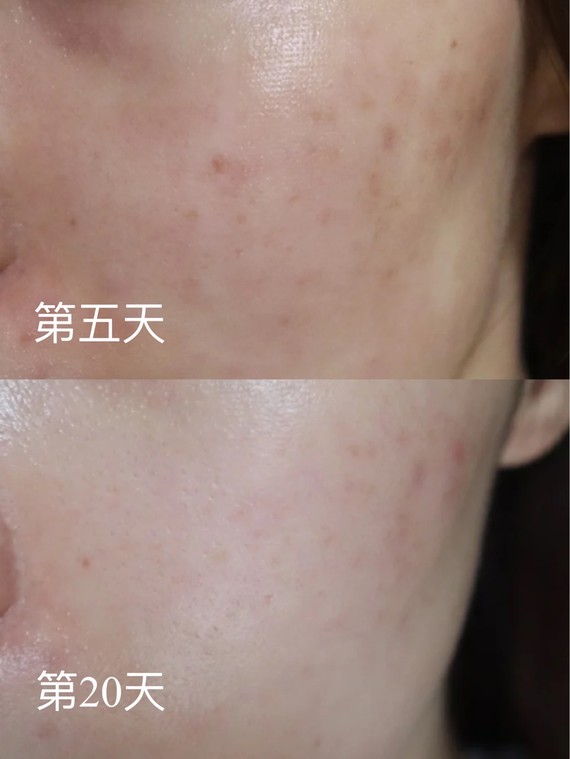 非剥脱点阵激光评测