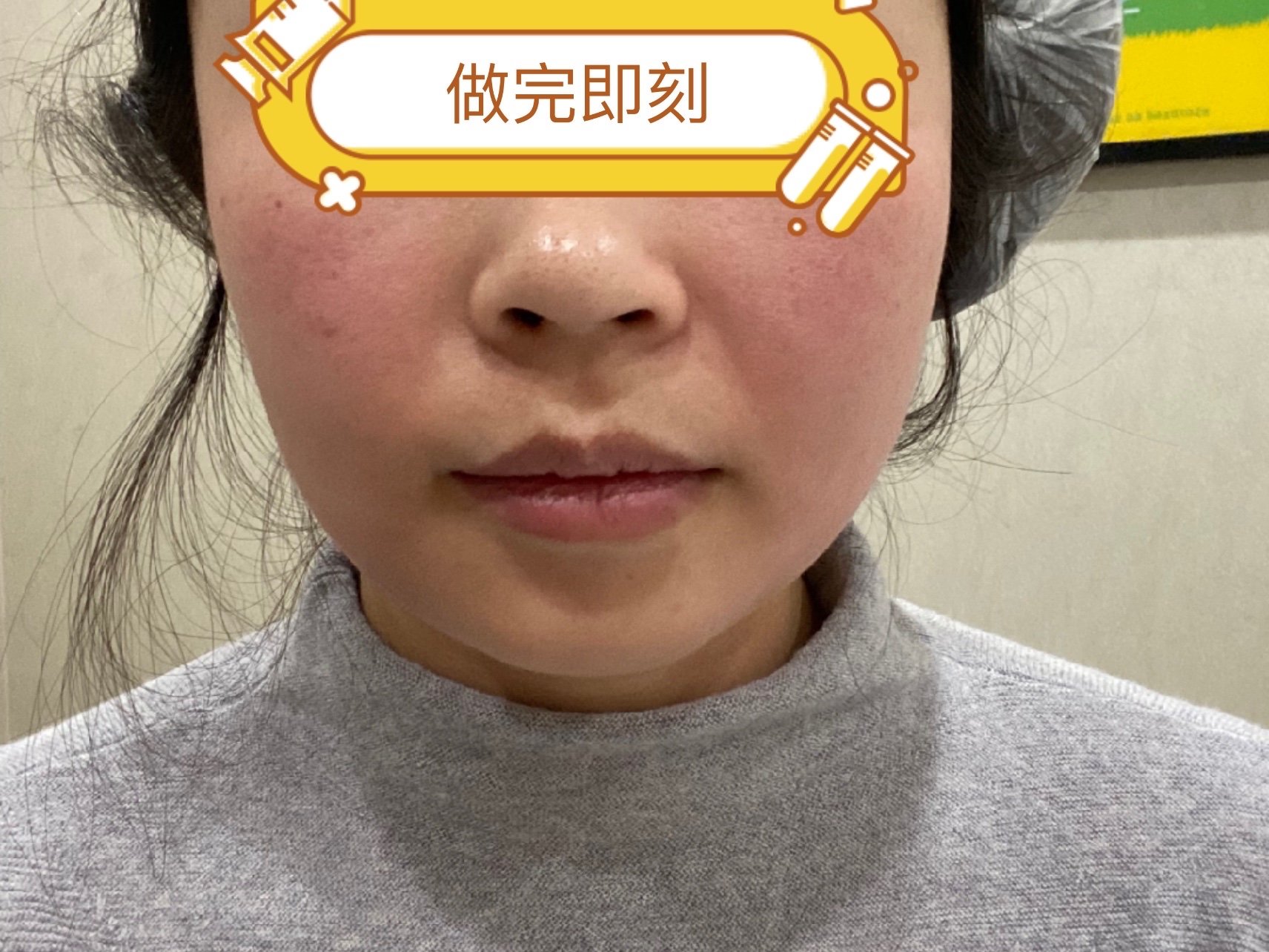 体验前变美诉求改善法令纹口角囊袋嘟嘟脸