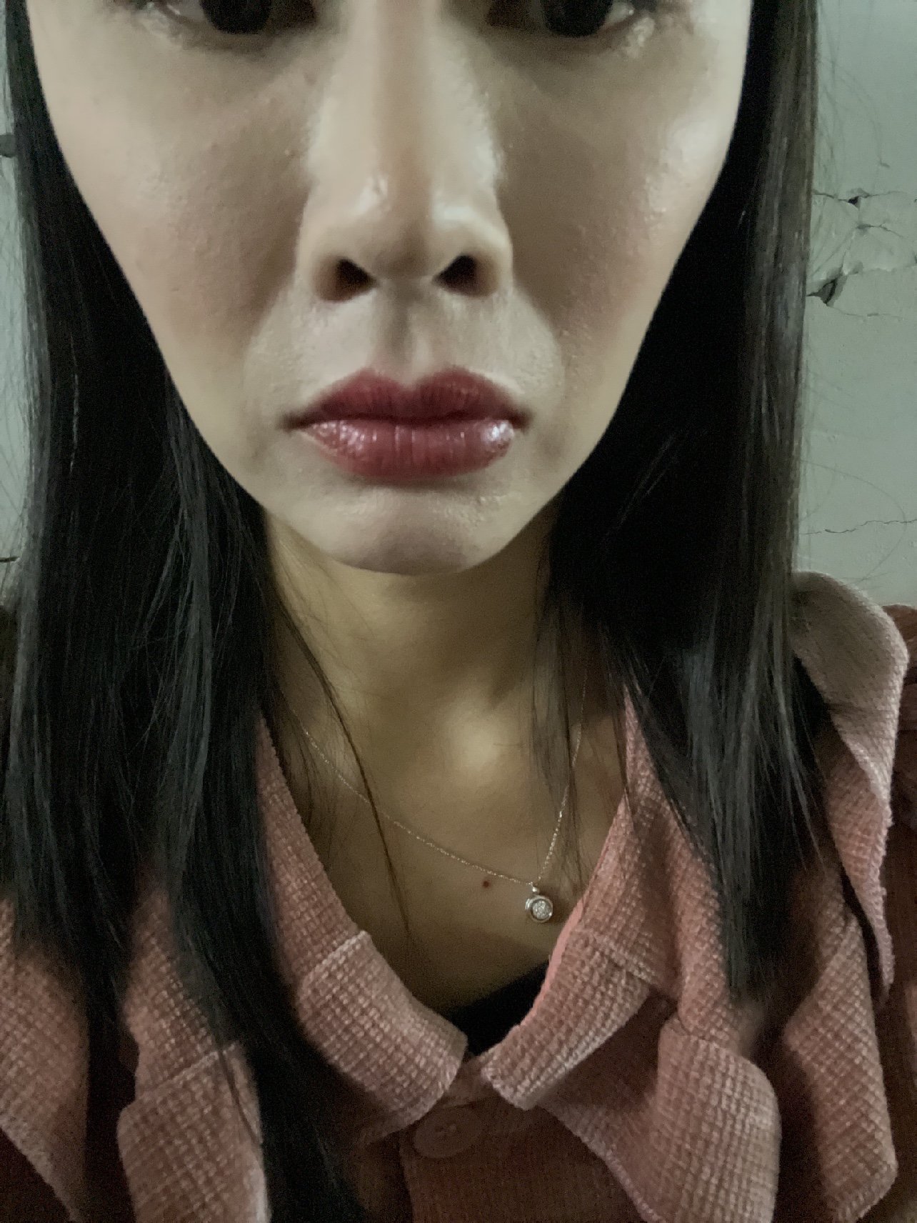 我想打瘦咬肌结果把我脸颊打凹陷了01