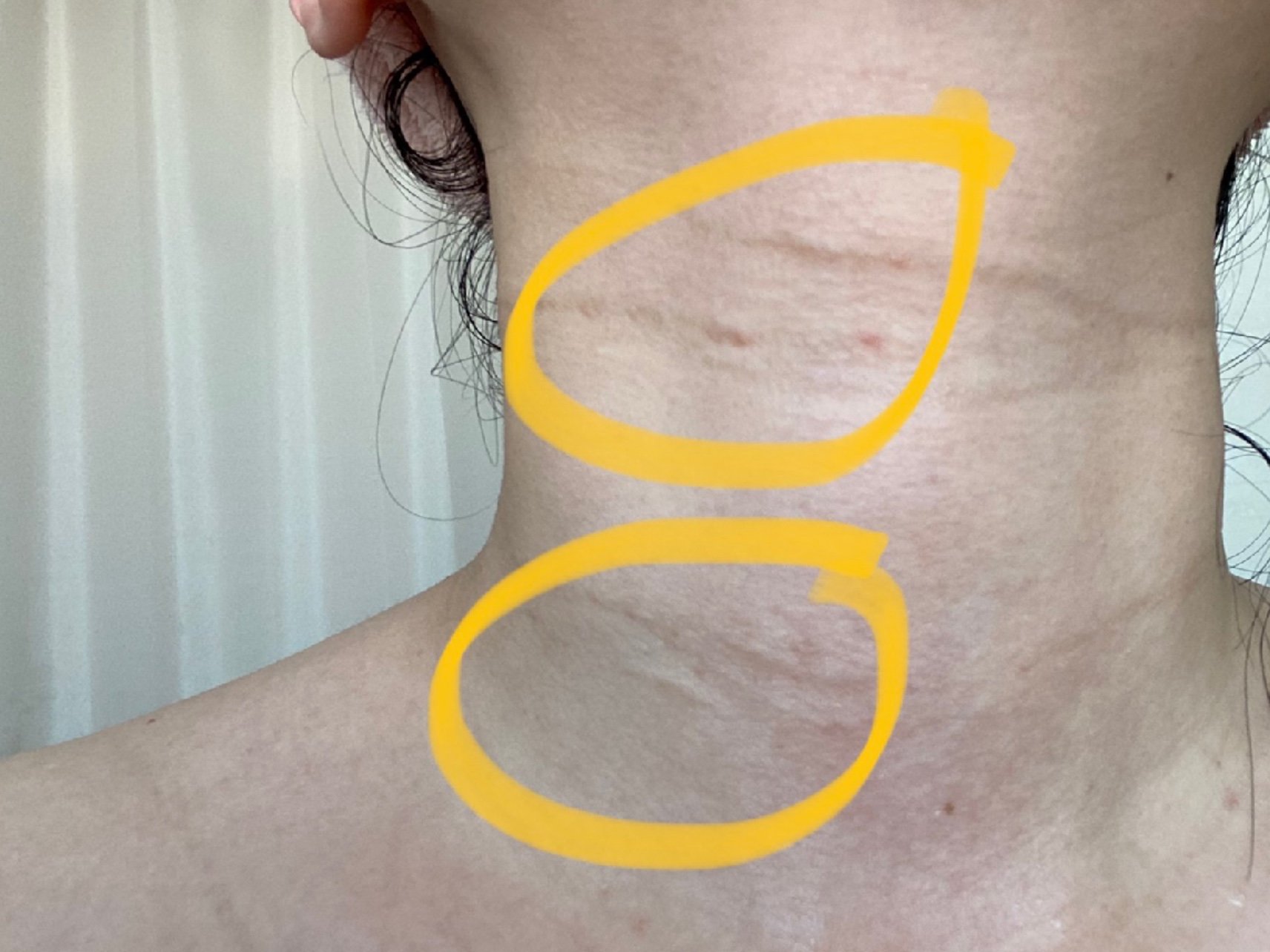 一过量注射导致鼓包