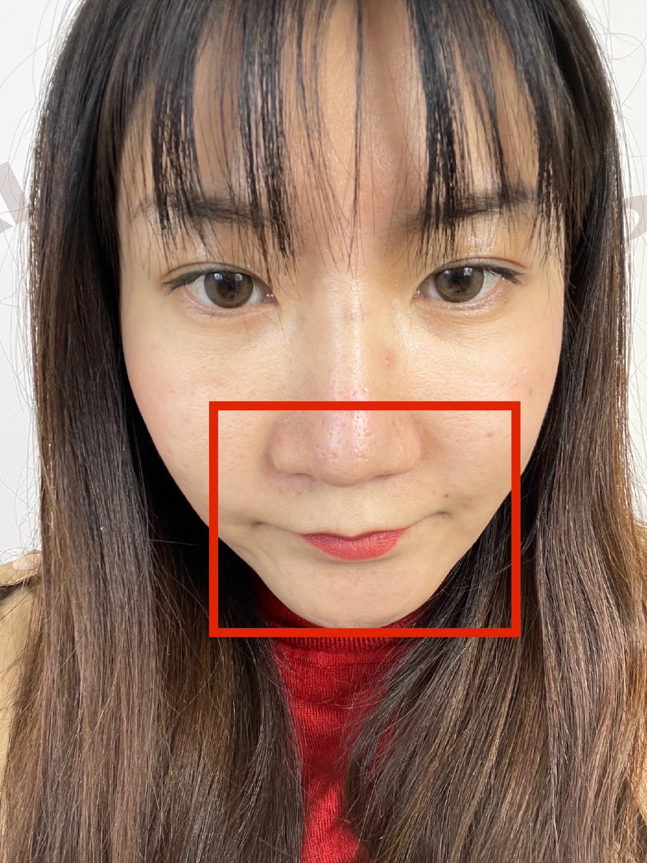 体验前变美诉求填充鼻基底法令纹