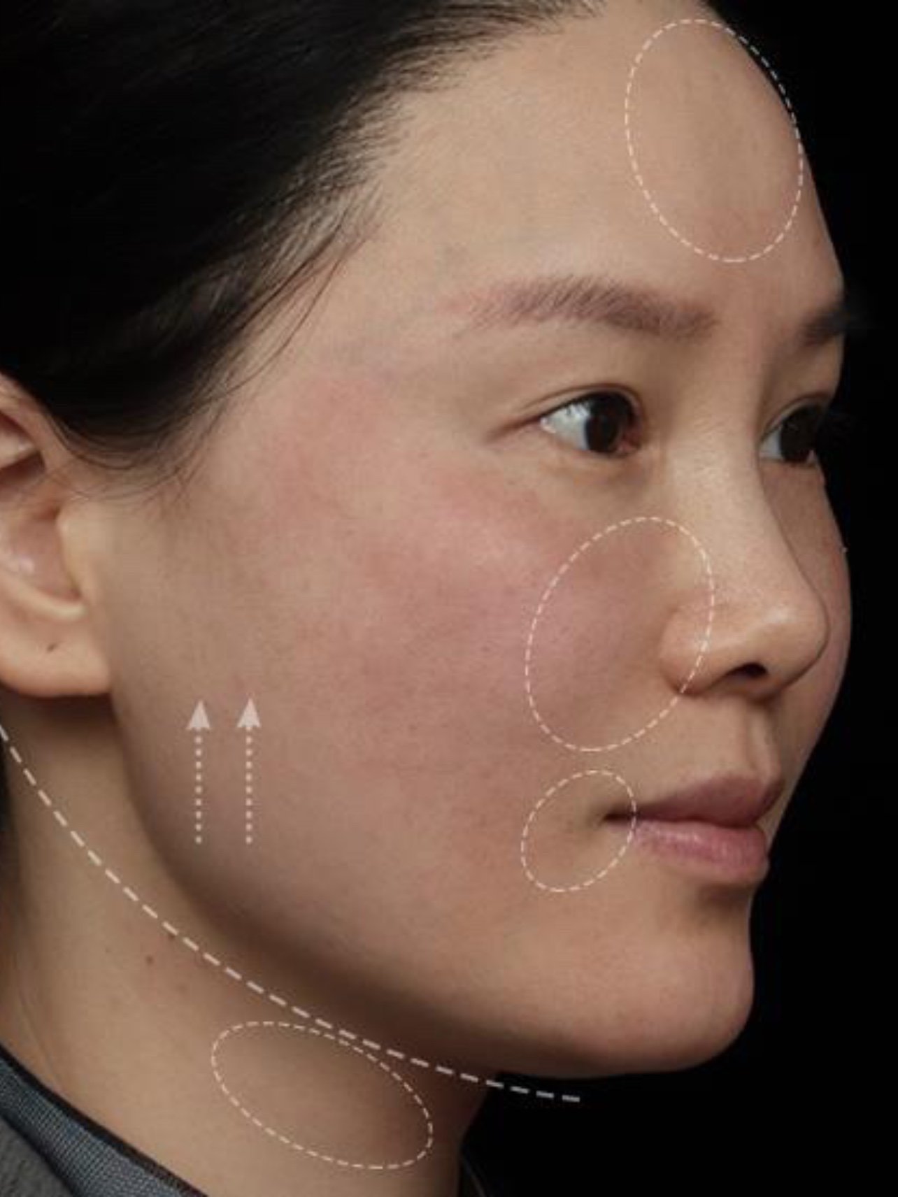 体验前变美诉求:面颊,法令纹凹陷明显,下颌缘下垂,_圈子-新氧美容整形