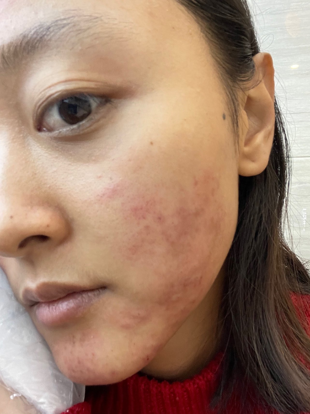 新氧试用官杏枝山祛斑 杏枝山治疗后第五天打卡97在_圈子-新氧美容