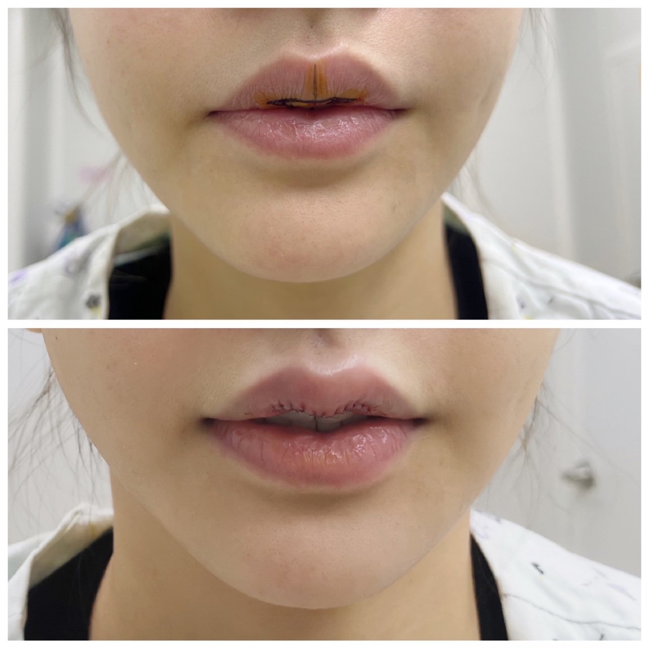 m唇记录一直觉得自己嘴巴不好看,没有唇珠,很平.如_圈子-新氧美容整形