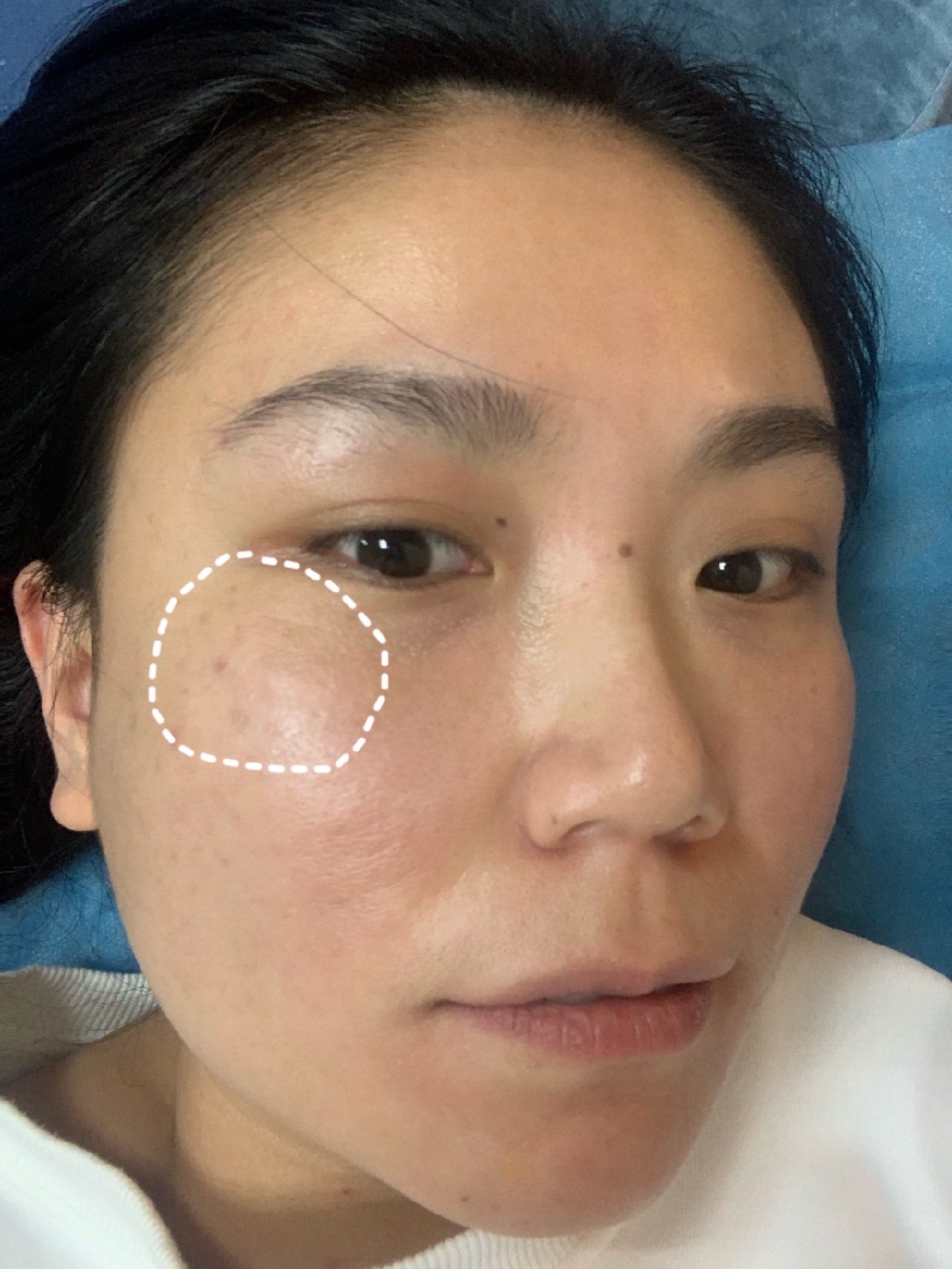 体验前变美诉求:78皮肤暗沉粗糙,有晒斑和颧骨处有一_圈子-新氧美容