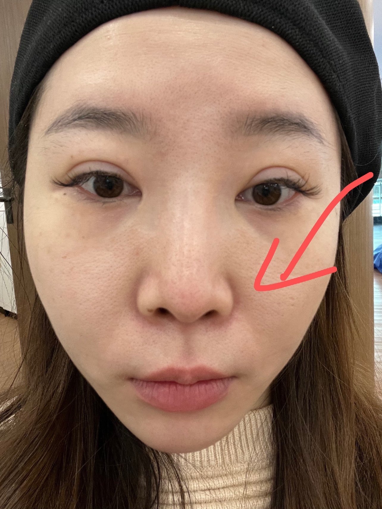 南京玻尿酸隆鼻整形美容（南京玻尿酸丰唇手术的价格） 南京玻尿酸隆鼻整形美容（南京玻尿酸丰唇手术的代价
）《南京玻尿酸丰唇哪家好》 整形美容