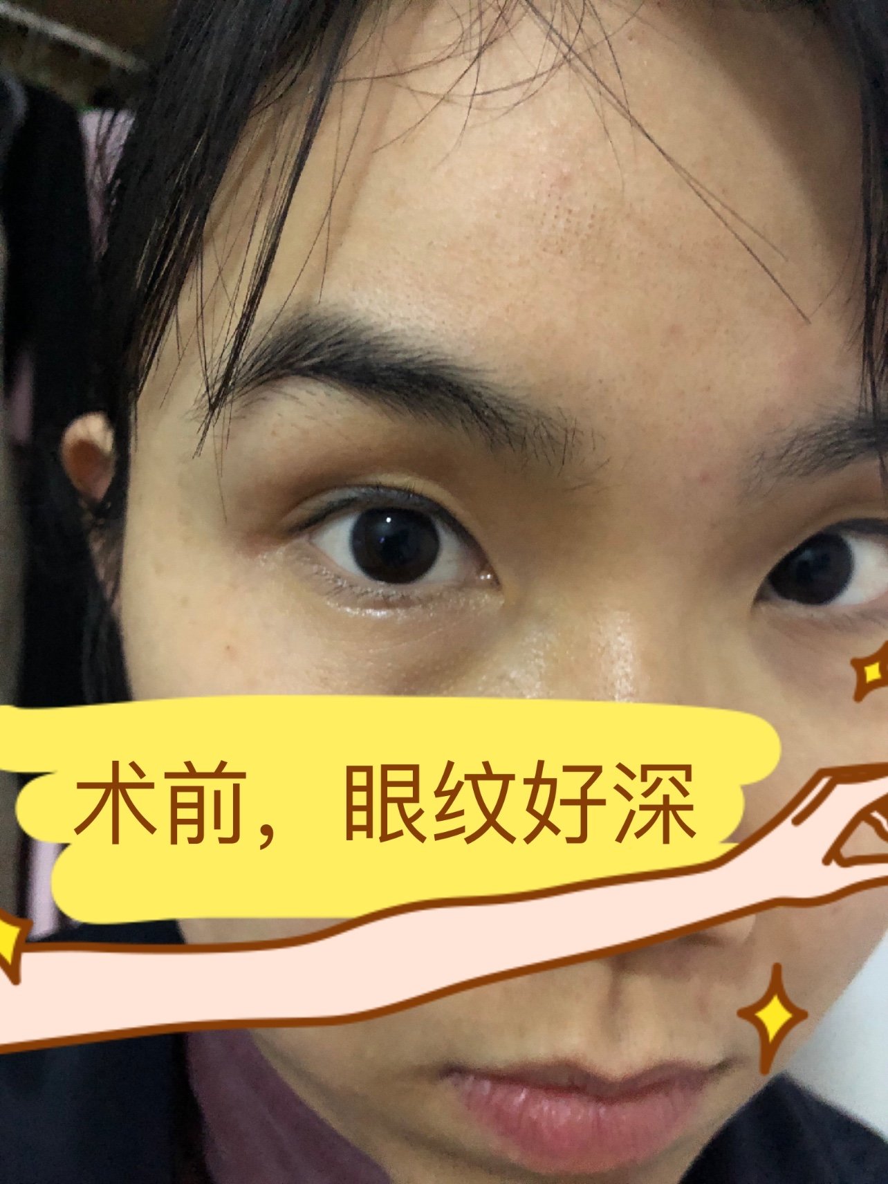 78体验前变美诉求下眼睑有细纹干纹随意年龄的增长越来越长自己超